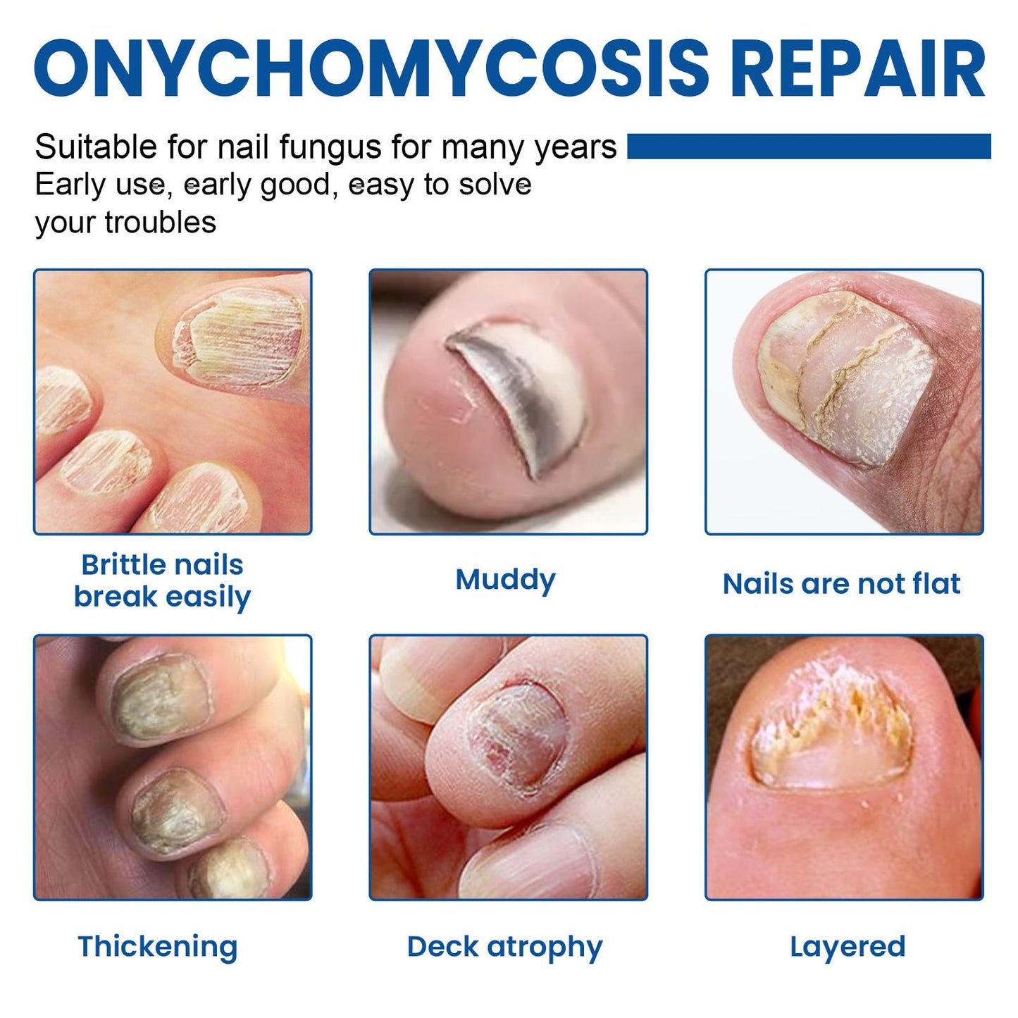 Fungal Nail Patches 60 Pcs,Upgraded Toe Nail Fungus Treatments,Nail Fungus Treatment Extra Strength,Toenail Fungus Treatment with Hydrogel for Overnight Repair Nail Fungus Patches