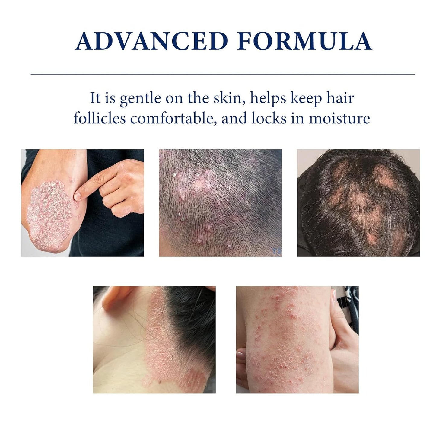 Folliculitis Care Cream - Soothing Formula for Razor Bumps & Ingrown Hairs | 120g