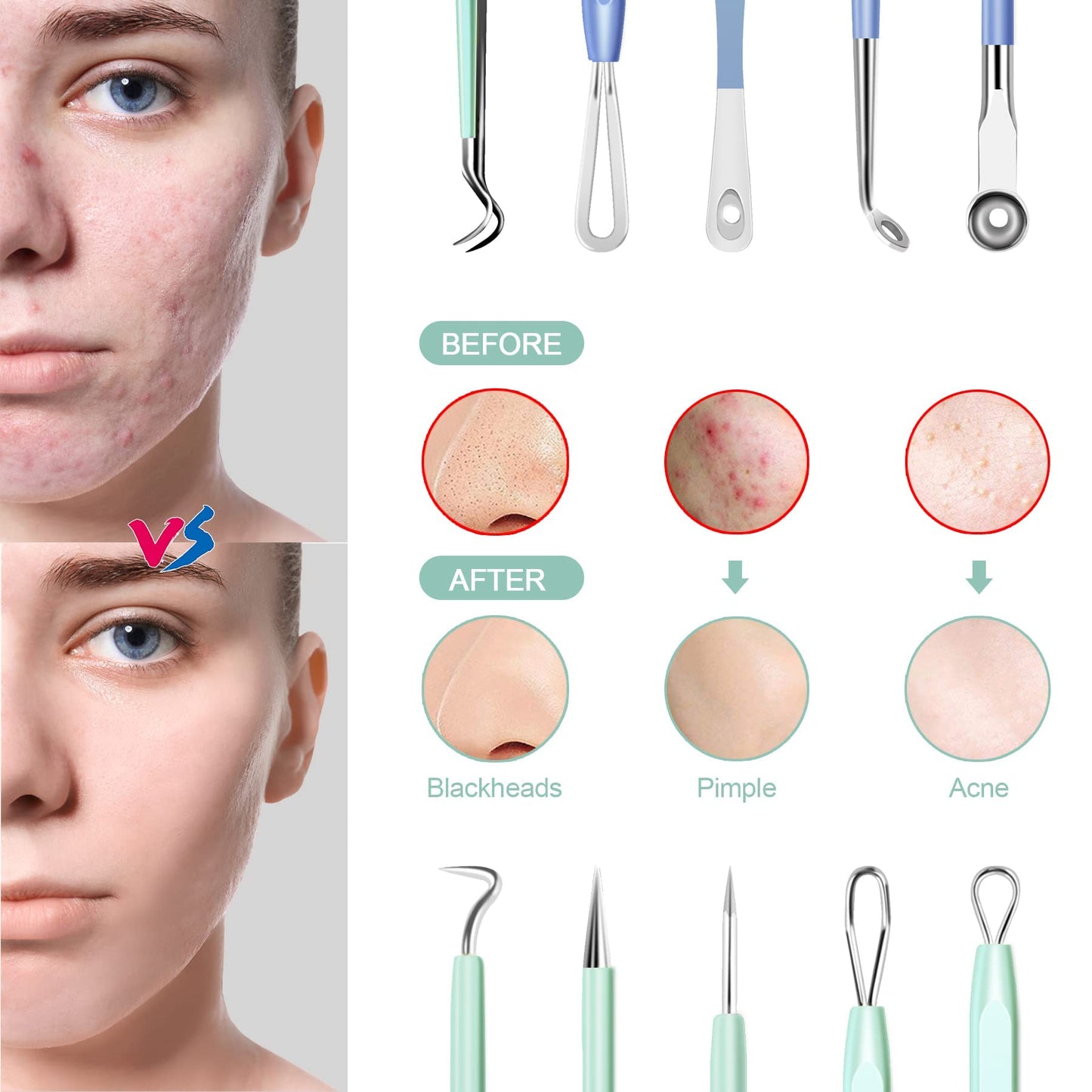 Blackhead Remover Tools MENOLY 10Pcs Pimple Popper Tool Kit, Blackhead Remover Extractor Tools, Anti-Slip Handle Pimple Comedone Extractor Acne Kit for Blackhead,Blemish,Zit Whitehead