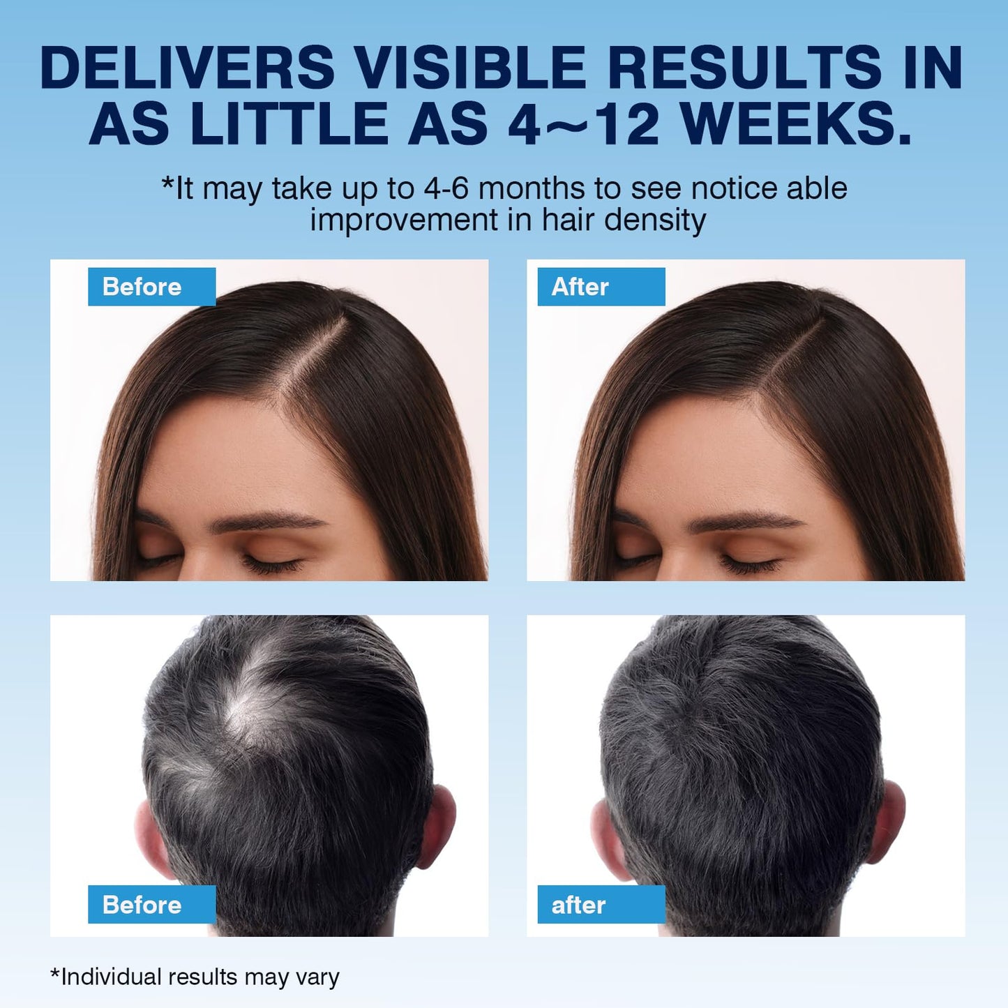 5% Minoxidil Foam– Hair Regrowth Treatment for Men & Women, Prevents Hair Thinning & Strengthens Roots, Minoxidil Foam for Fuller, Healthier Hair,9.52 Ounce (Pack of 1)