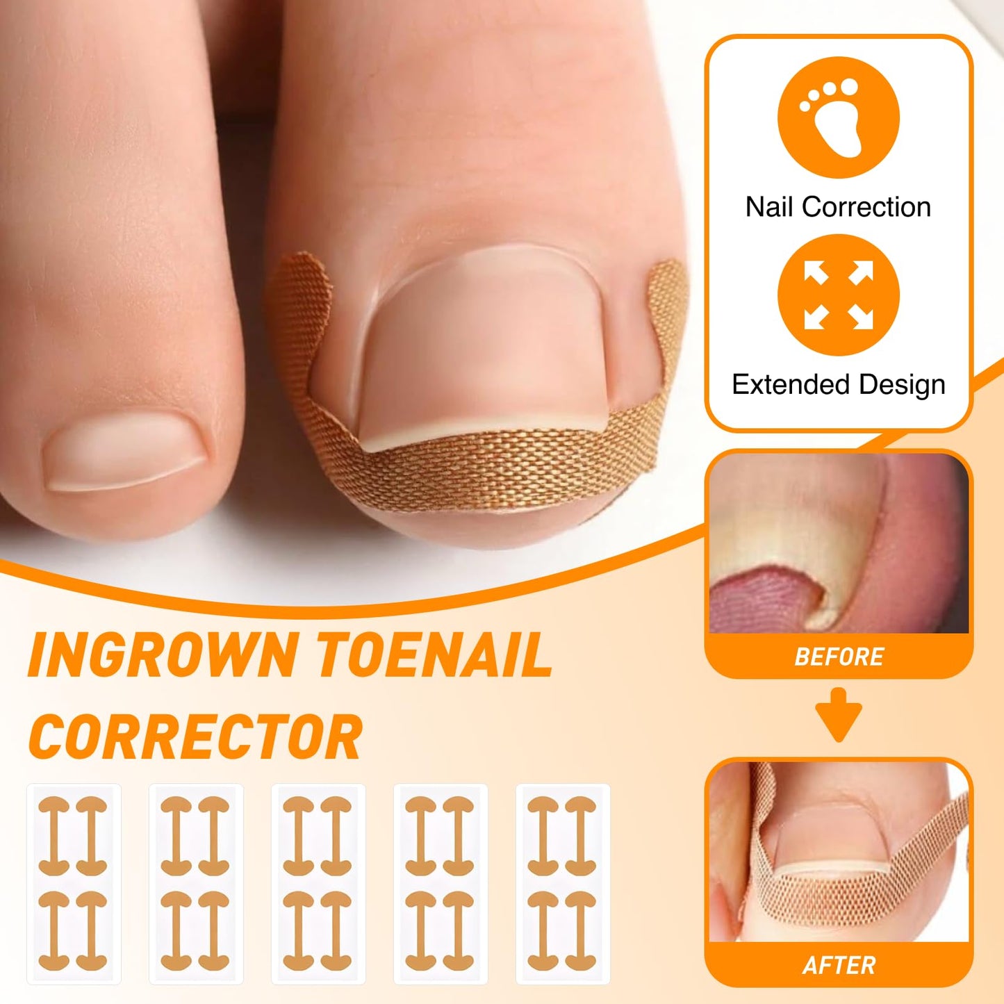 Ingrown Toenail Corrector Set, Ingrown Toenail Treatment Kit Including Correction Strips, Pedicure Tools & Breathable Patches - Professional Home Pedicure Care for Curved Toenails