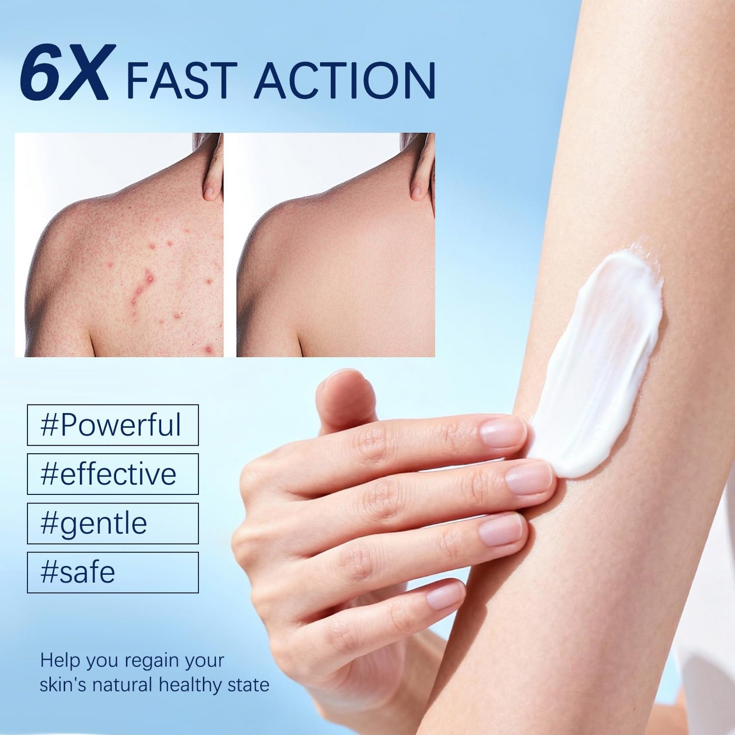 Folliculitis Cream - Soothes & Clears Bumps on Scalp, Face, Body | Ingrown Hairs & Razor Bumps Relief | 120g
