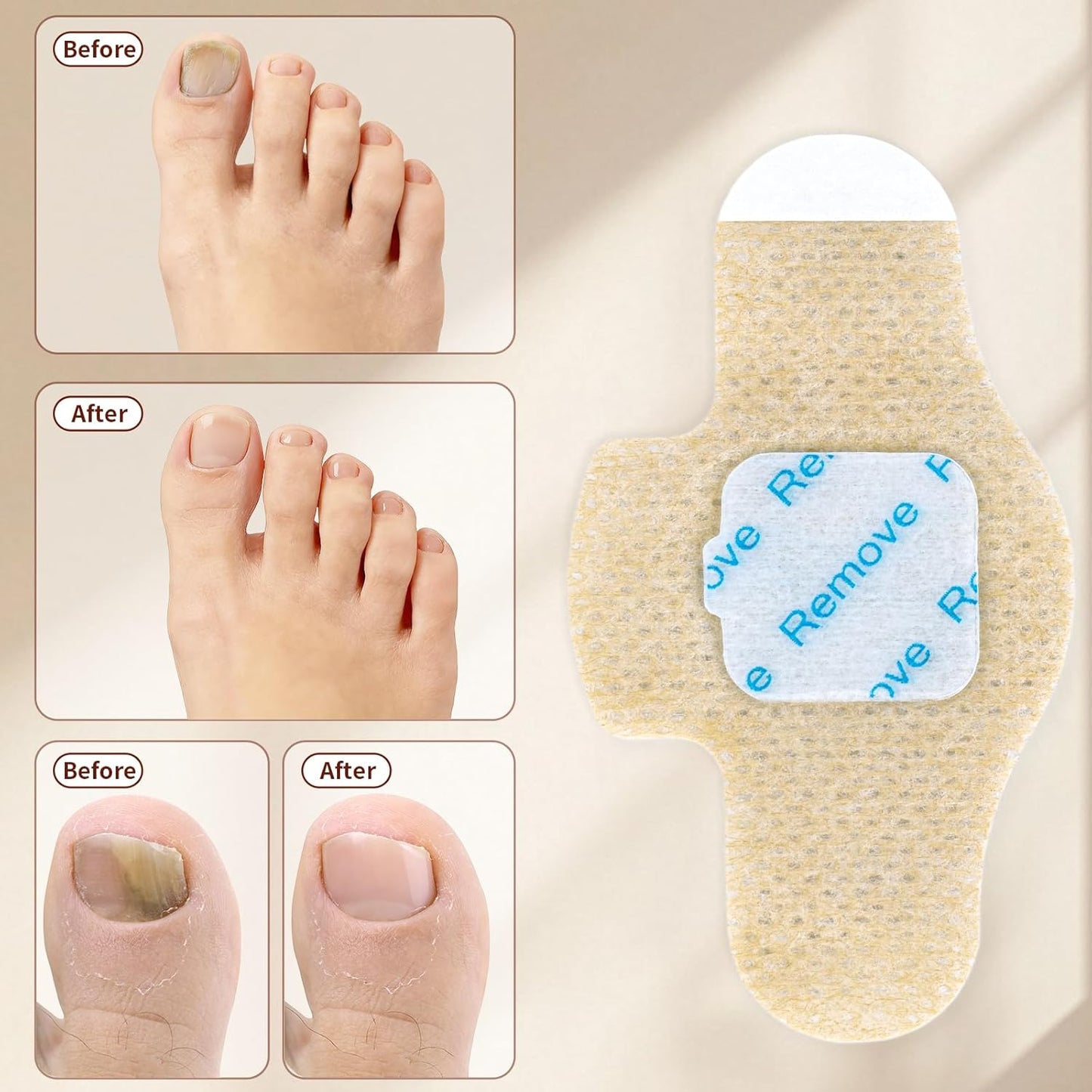 Fungal Nail Patches - 42 Pcs Nail Repair Patches for Discolored & Damaged Toenails | 9-Hour Adhesion, Overnight Renewal