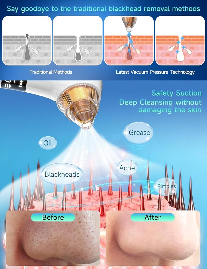 Blackhead Remover Pore Vacuum - 6MP HD Camera, 25X Magnification, 5 Suction Levels | Deep Cleansing Tool for Acne