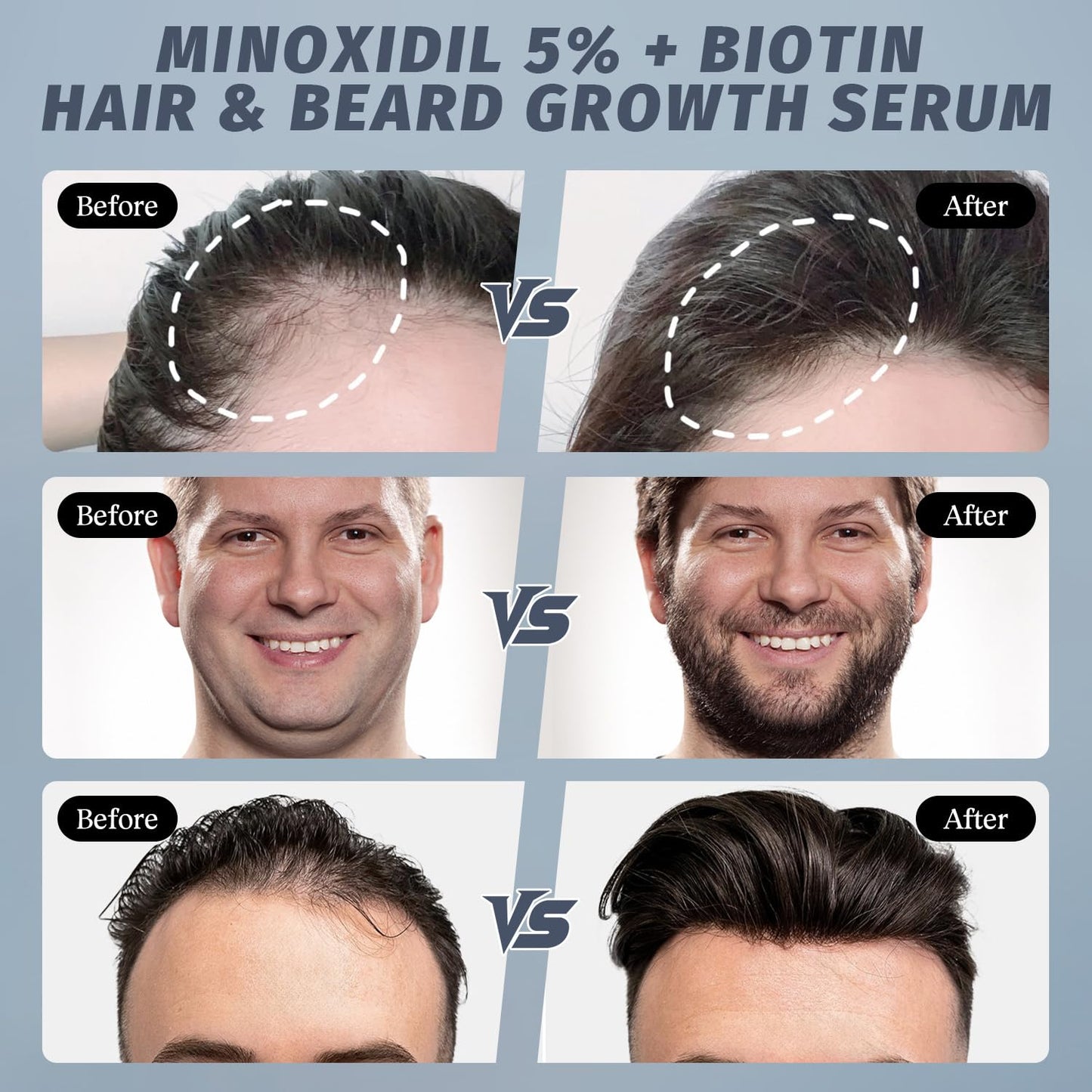 Minoxidil Spray for Hair Growth - Effective Treatment for Thinning Hair & Receding Hairline | 4 oz with Rosemary Extract