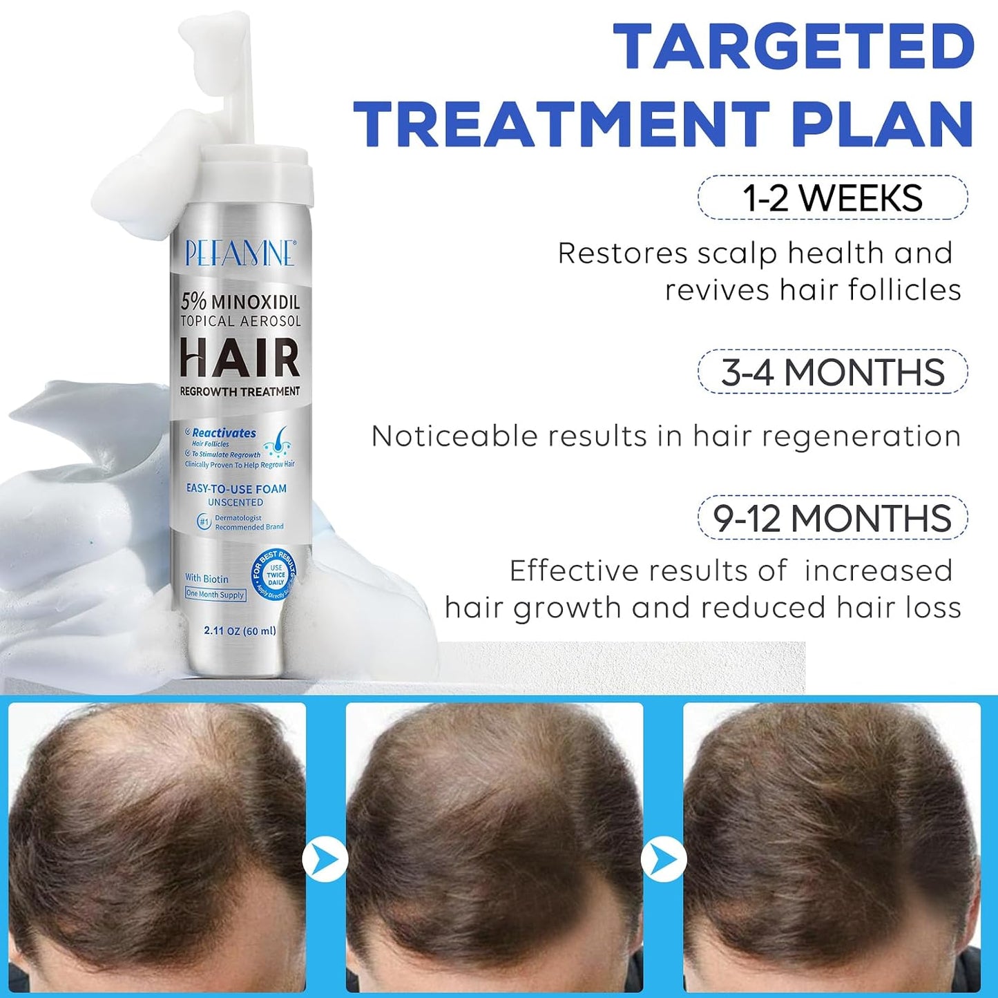 Minoxidil Hair Growth Foam - Effective Treatment for Hair Thinning & Scalp Loss | For Men & Women