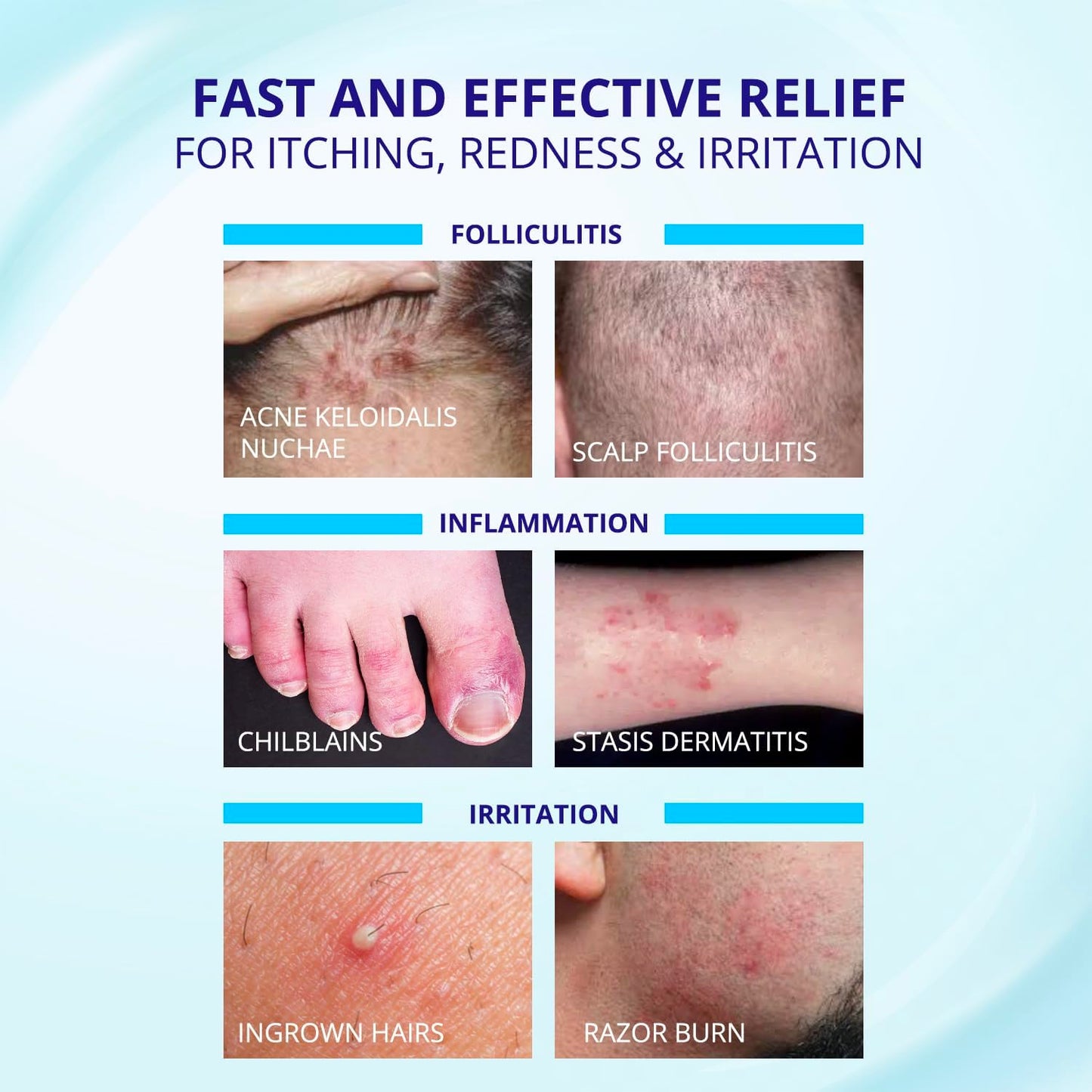 TAGRID Folliculitis Treatment Cream | Ingrown Hair Relief for Scalp, Face & Body - Hydrating & Soothing Formula