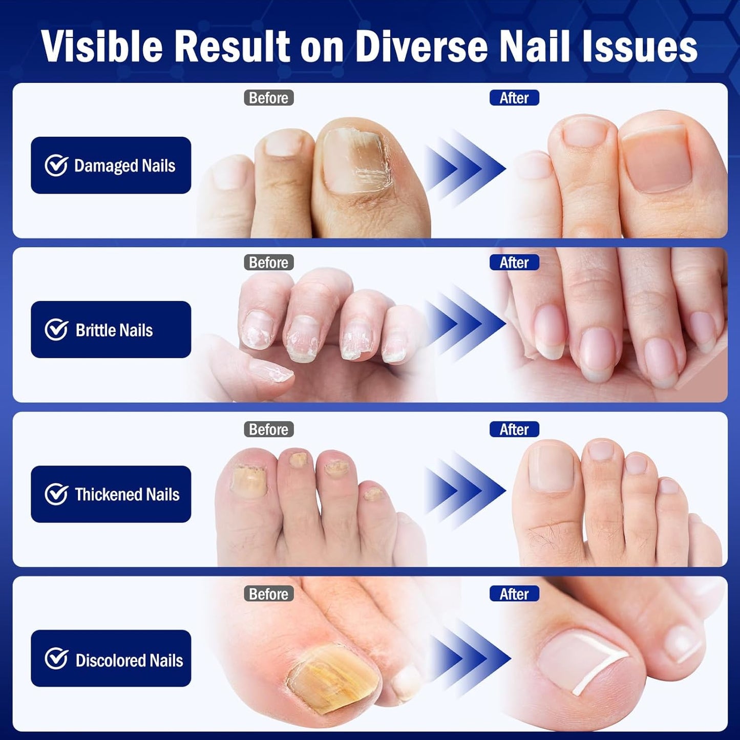 Toe Nail Fungus Renewal Treatment - Fast Acting Solution for Thick, Discolored Nails | 2-Pack