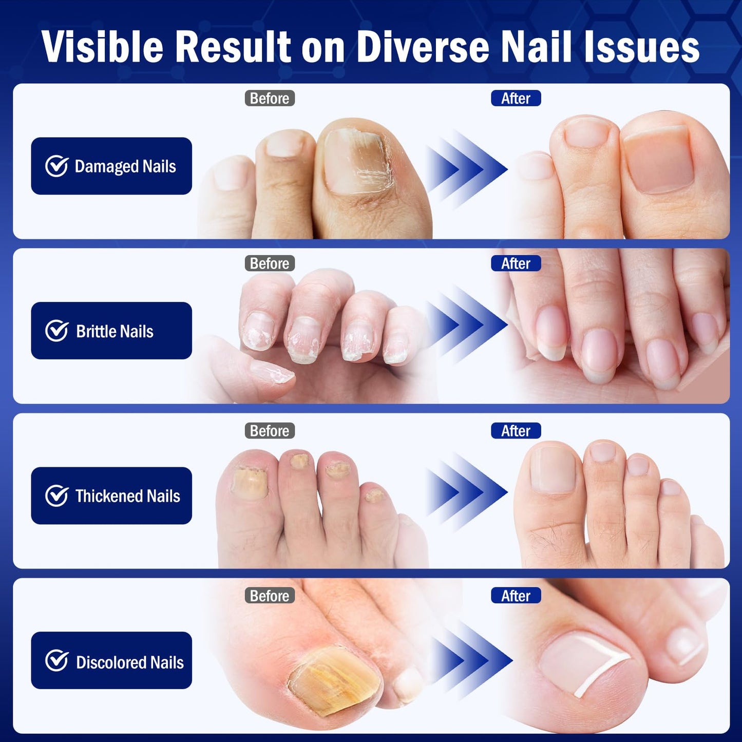 Toe Nail Fungus Renewal, 12 Packs Toenail Fungus Renewal, Fast Acting For Thick, Discolored, Broken & Damaged Toe & Finger Nail