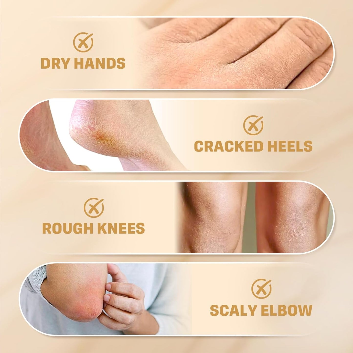 60% Urea Cream with 2% Salicylic Acid - Maximum Strength Moisturizer for Dry, Cracked Skin | 150g, Deep Hydration for Feet & Hands