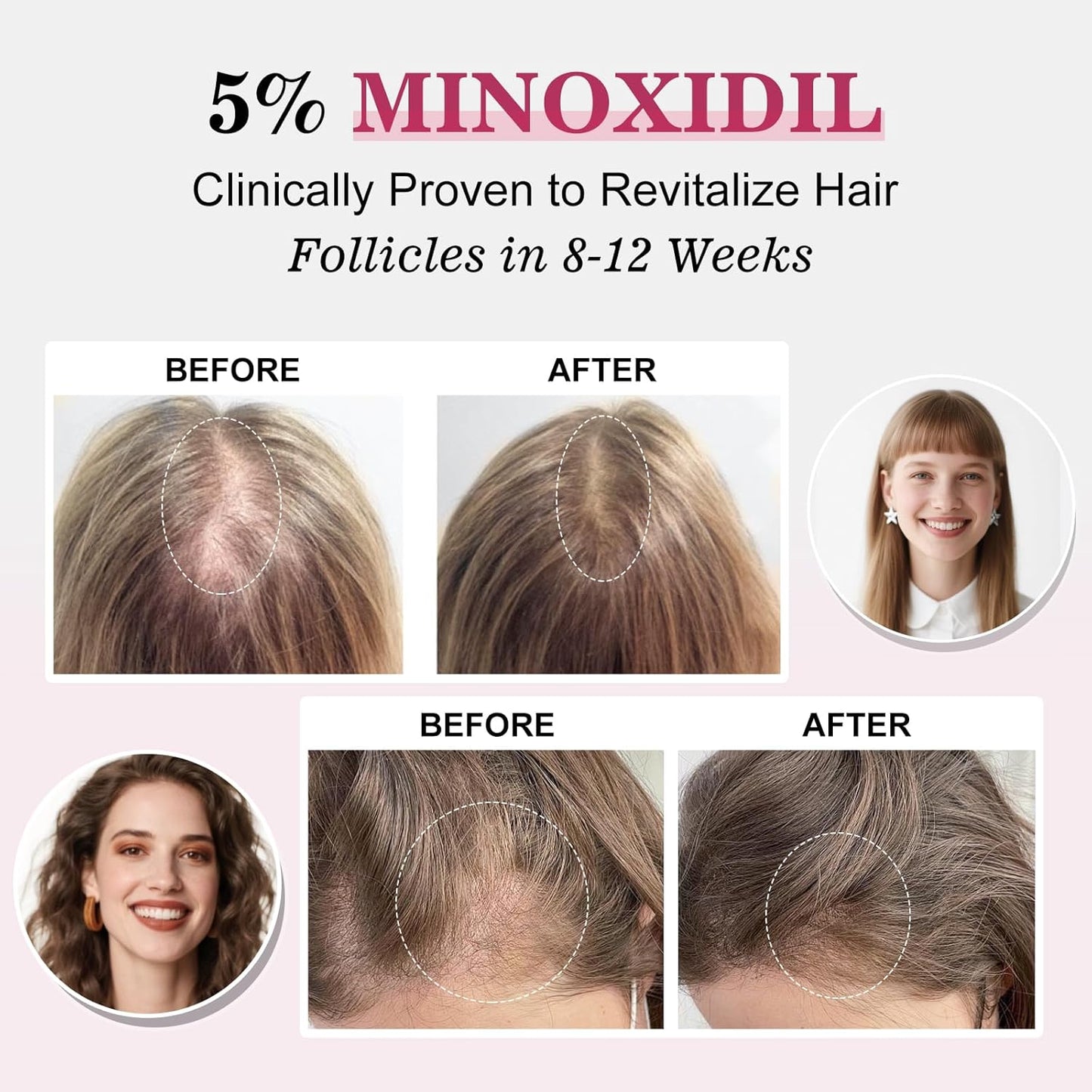 Minoxidil Hair Regrowth Spray for Women - Extra Strength Biotin-Infused Treatment | 3 Bottles