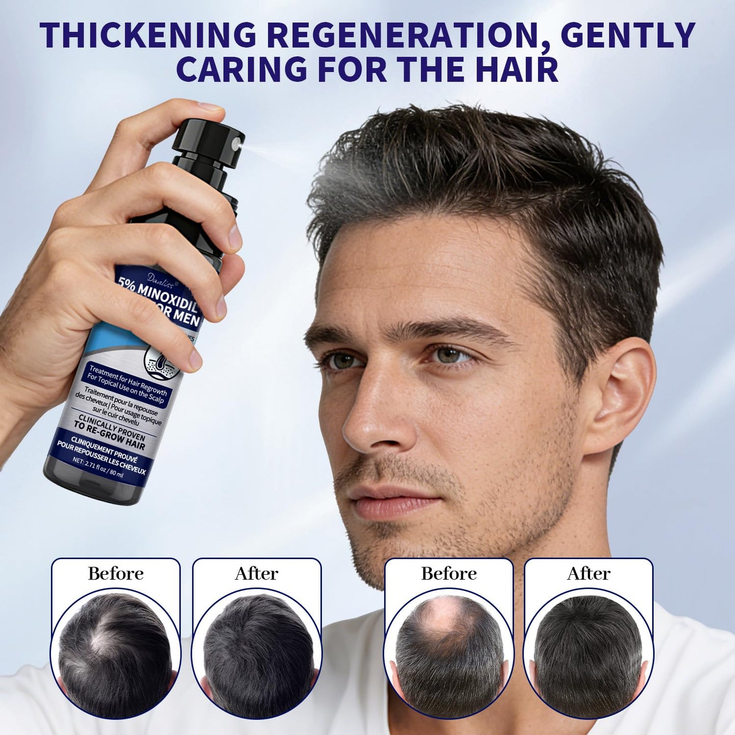 Minoxidil for Men - Extra Strength Hair Loss Solution with Biotin & Rosemary | 160 ml (Pack of 2)