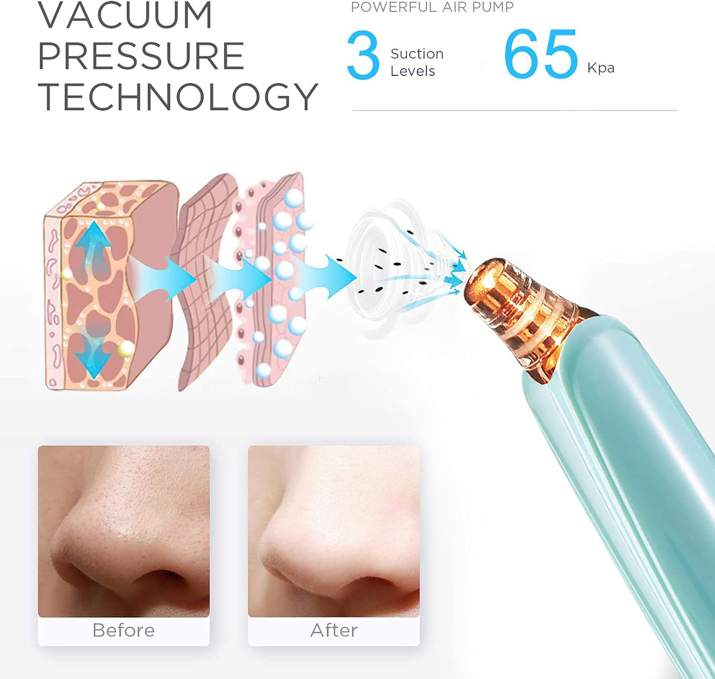 Blackhead Remover Pore Vacuum - Electric Facial Cleaner with 5 Probes | USB Rechargeable Suction Tool