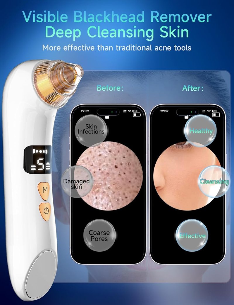 Blackhead Remover Pore Vacuum - 6MP HD Camera, 25X Magnification, 5 Suction Levels | Deep Cleansing Tool for Acne