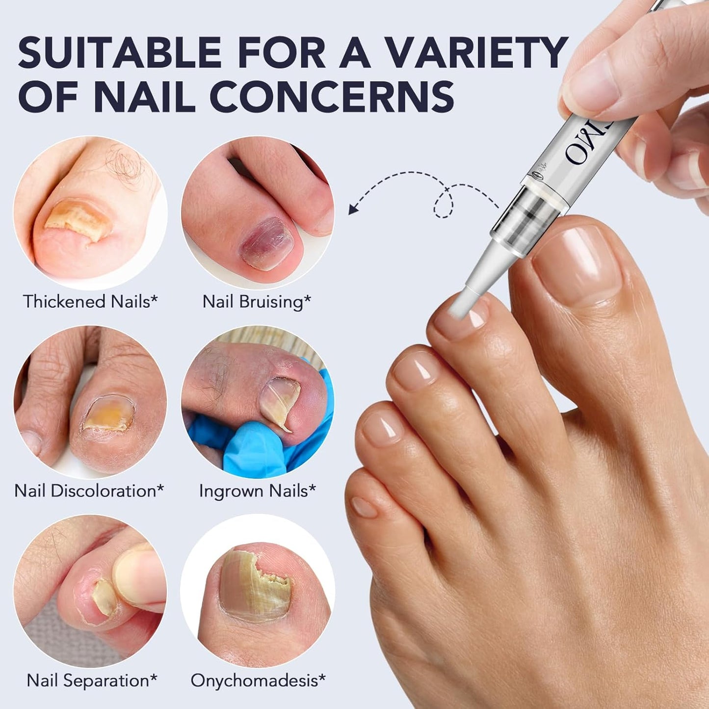 Toenail Fungus Treatment Pen - Extra Strength 25% Undecylenic Acid | Tea Tree & Jojoba - 5 Pack Fungal Nail Repair Kit