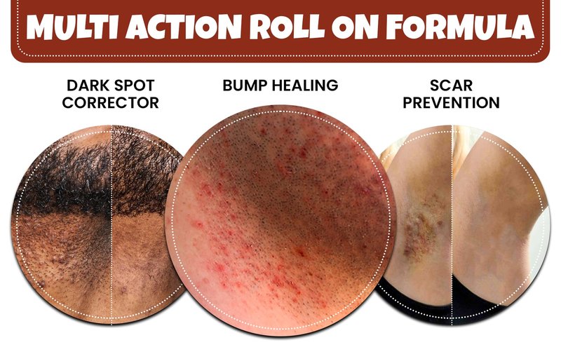 BUMP Terminator EXTRA STRENGTH, Fast Acting, Alcohol BASED, Water Free Anti Razor Bumps, Ingrown Hair, Skin Treatment for Face, Neck, Bikini Area, Legs & Back Of Head Bumps Remover, Unisex Roll On