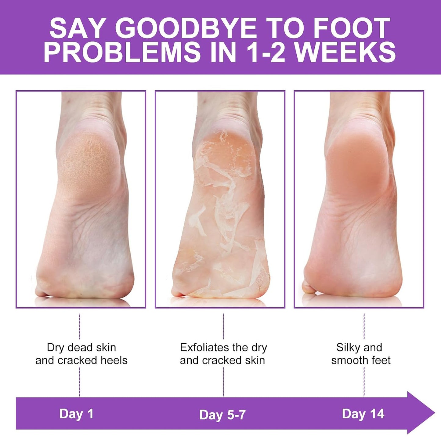 Foot Peel Mask - 5 Pack Exfoliating Treatment for Dead Skin, Calluses & Cracked Heels | Lavender Scent