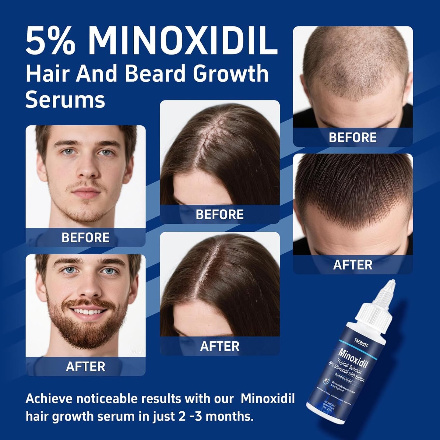 Minoxidil Hair Growth Treatment - 5% with Biotin for Thicker Hair & Beard | 6 Pack, 12 fl oz