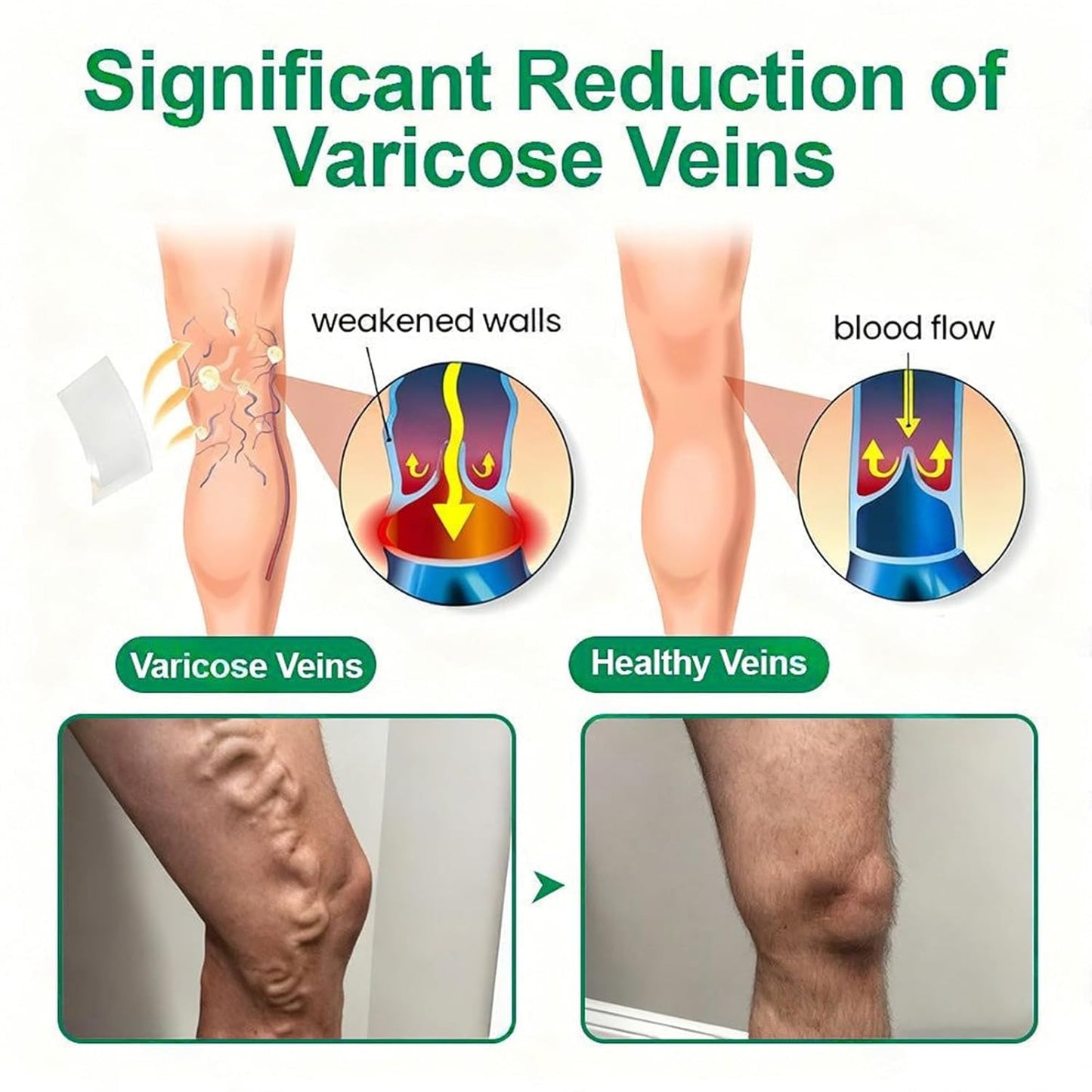 Healrize Vein Target Microdarts Patch - Natural Varicose Vein Treatment for All Skin Types | 2 Boxes