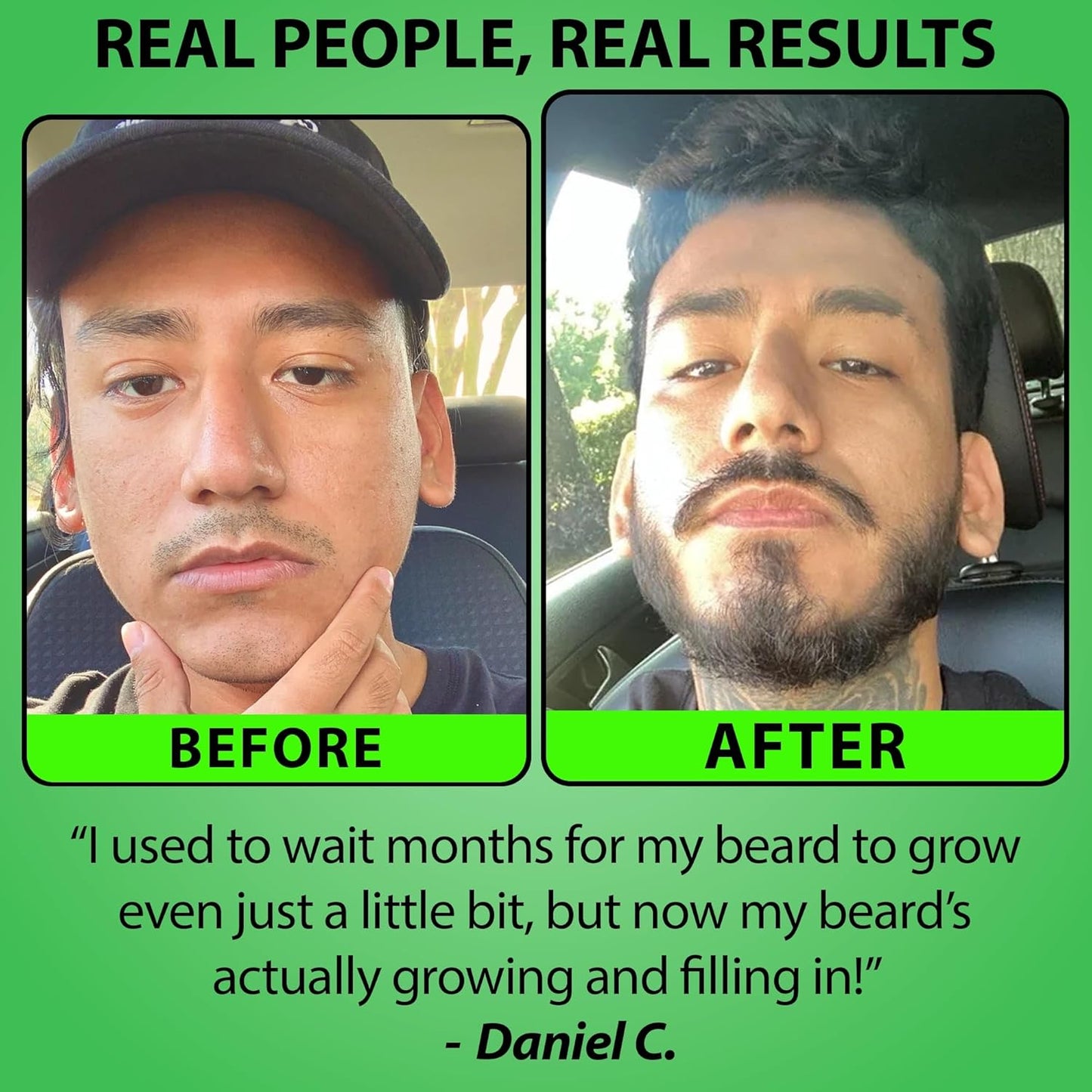 Minoxidil Beard Growth Serum - 5% Formula with 2X Biotin & Rice Water for Thicker Facial Hair | Ideal for Patchy Areas