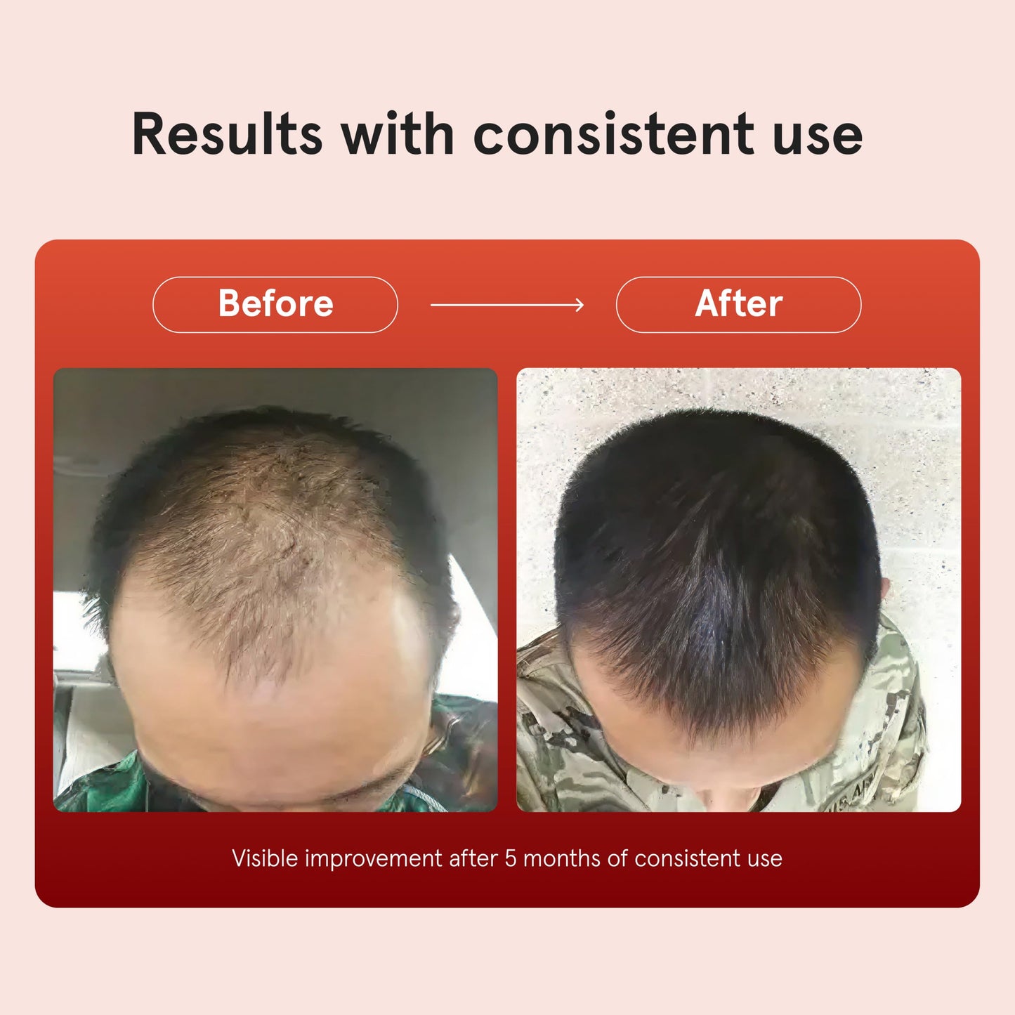 Keeps Minoxidil Solution 5% for Men - Extra Strength Topical Hair Regrowth Treatment - Non-Greasy Scalp Solution - Clinically Proven to Increase Hair Growth - 3 Month Supply (3 x 2 fl oz Bottles)