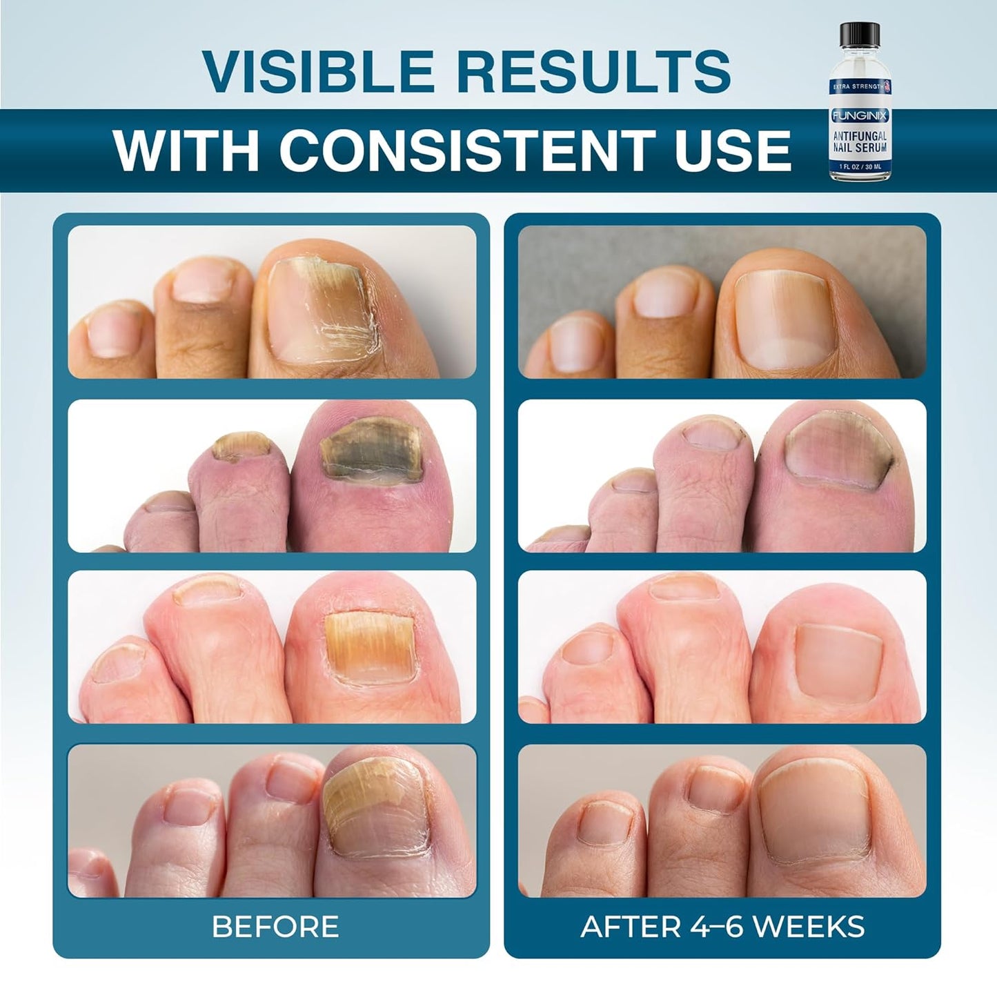 Fungus Treatment - Extra Strength Solution for Toe, Finger & Foot Fungus | Made in the USA (1 Bottle)
