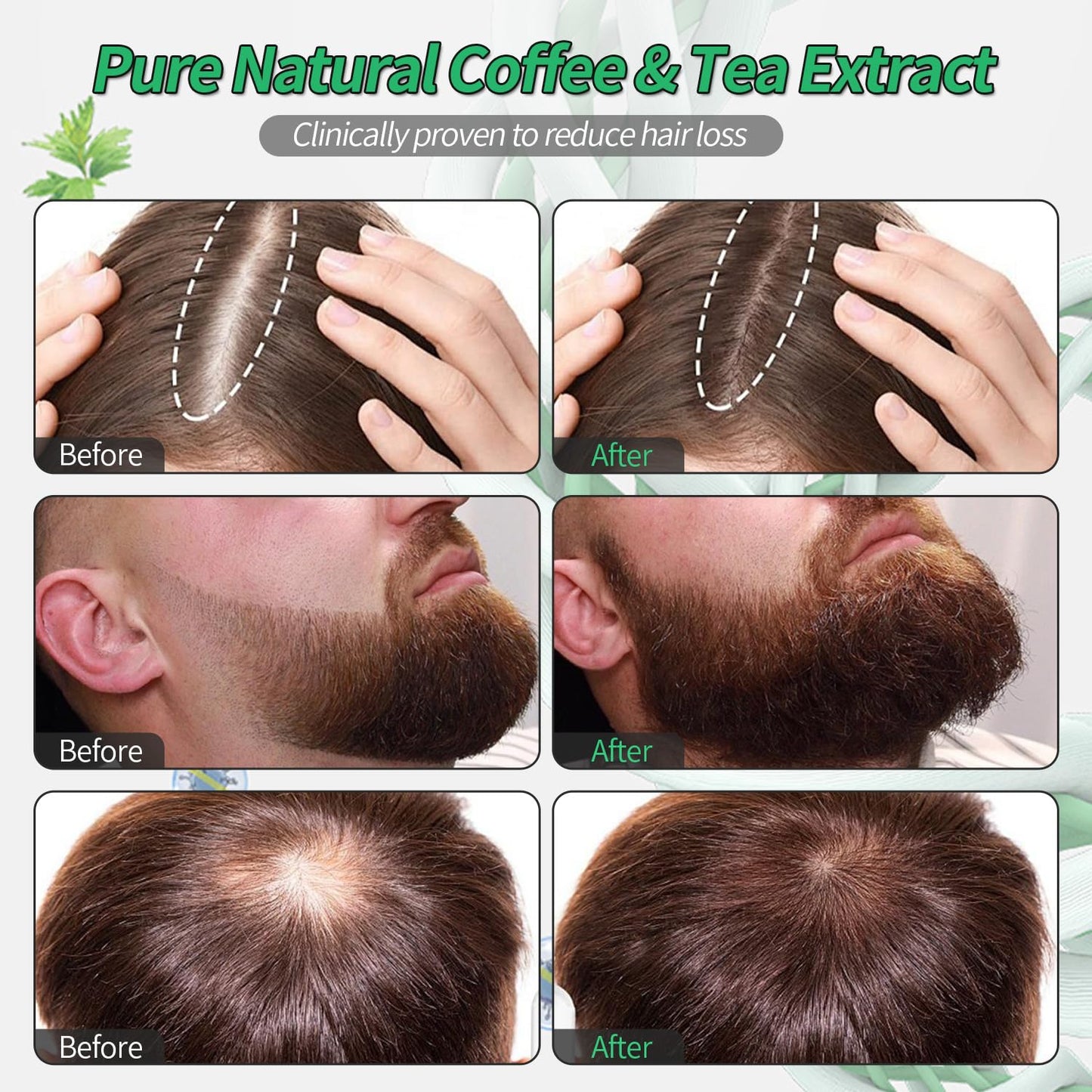 Revitalize Hair with Orrenaturals Hair Growth Serum - 3% Rosemary Roll-On, 30ml for Thinning Hair