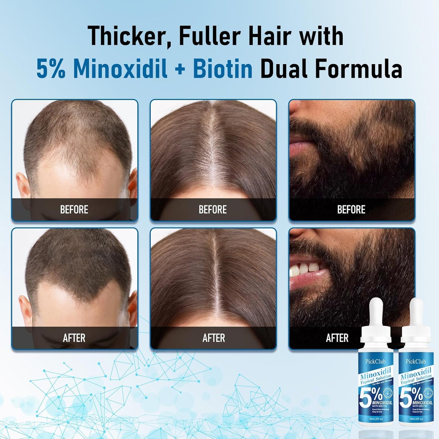 Minoxidil 5% Hair & Beard Regrowth Serum - Biotin Infused, Fast-Absorbing | 4-Pack (8.12 fl oz)