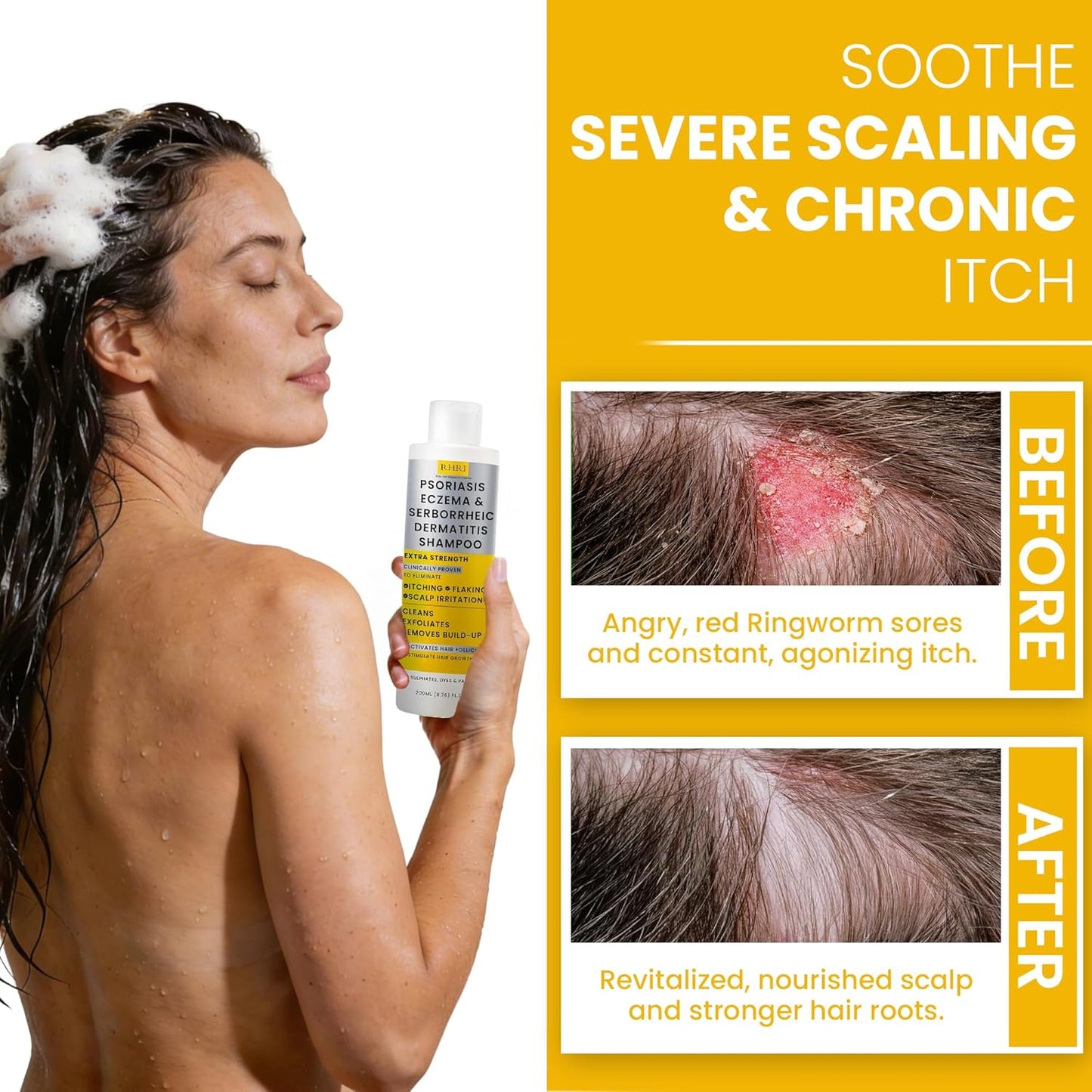 Psoriasis Shampoo for Men & Women - Itchy Scalp Treatment with Manuka Honey | Eczema & Dermatitis Relief