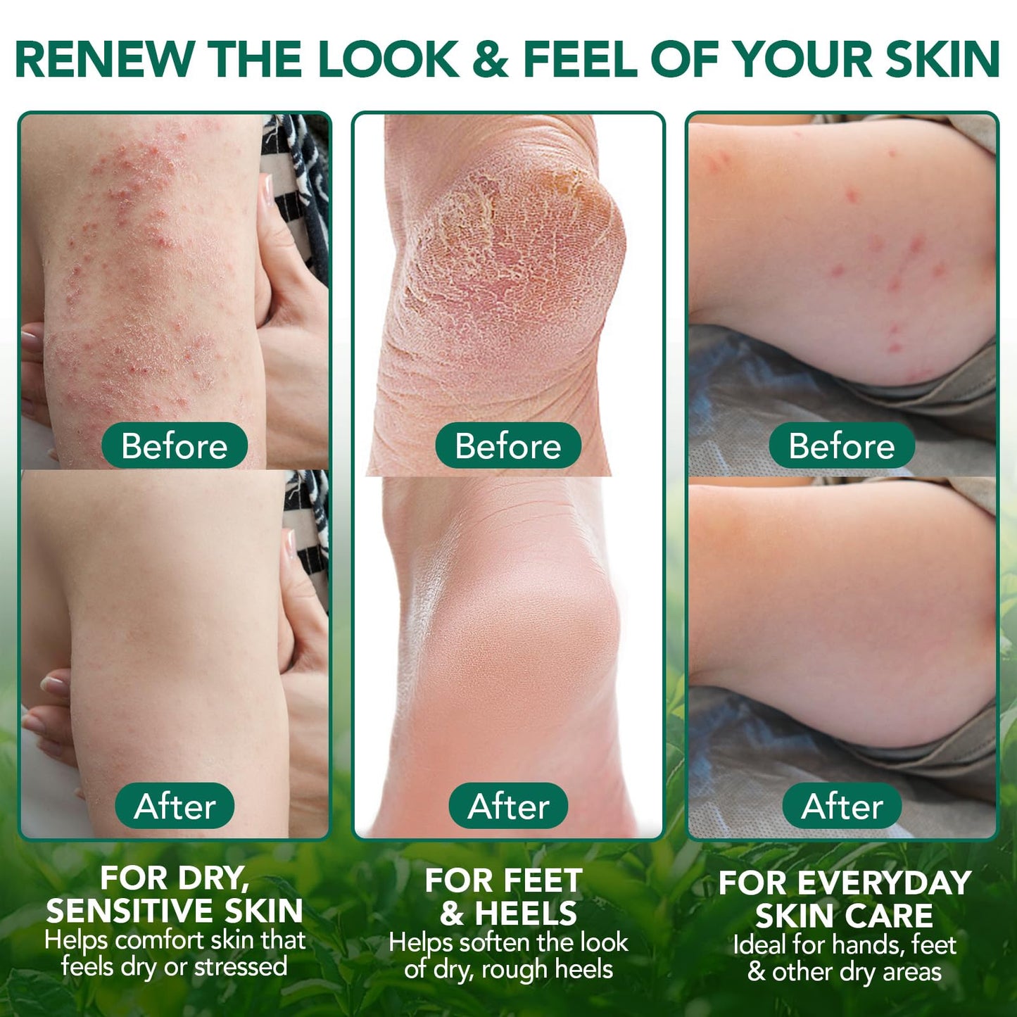bnHUlMXw Tea Tree Oil Balm,Tea Tree Oil for Skin,Dry Itchy Skin & Rash Relief, Athlete’s Foot & Dry Feet Itching, Jock Itch, Chafing, Bug Bites,Natural Formula,Effective & Safe for All Ages