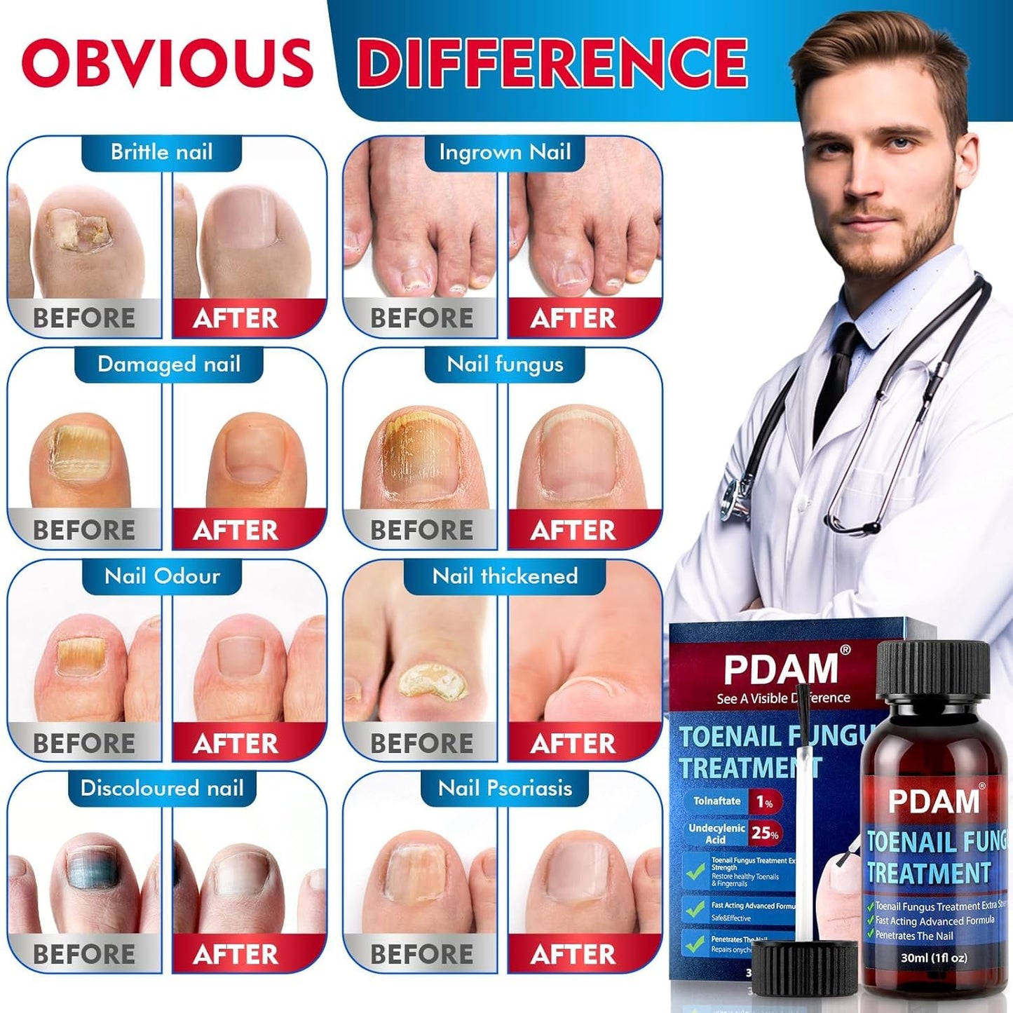 Toenail Fungus Treatment - Extra Strength Nail Strengthener for Thick, Discolored & Ingrown Nails | 30ml