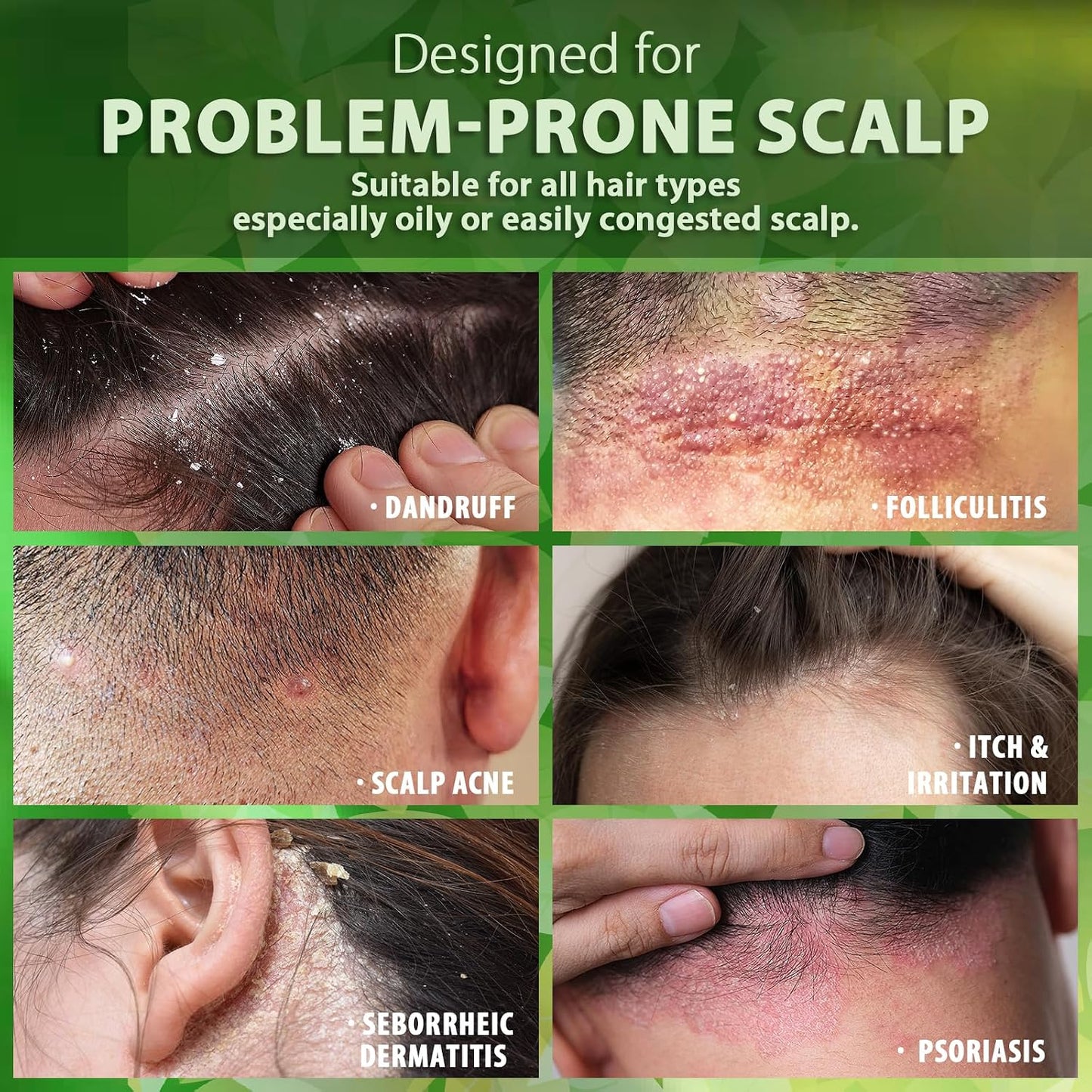 Folliculitis Treatment Shampoo - Anti-Fungal Scalp Cleanser for Seborrheic Dermatitis & Psoriasis | Sulfate-Free, Itchy Scalp Relief