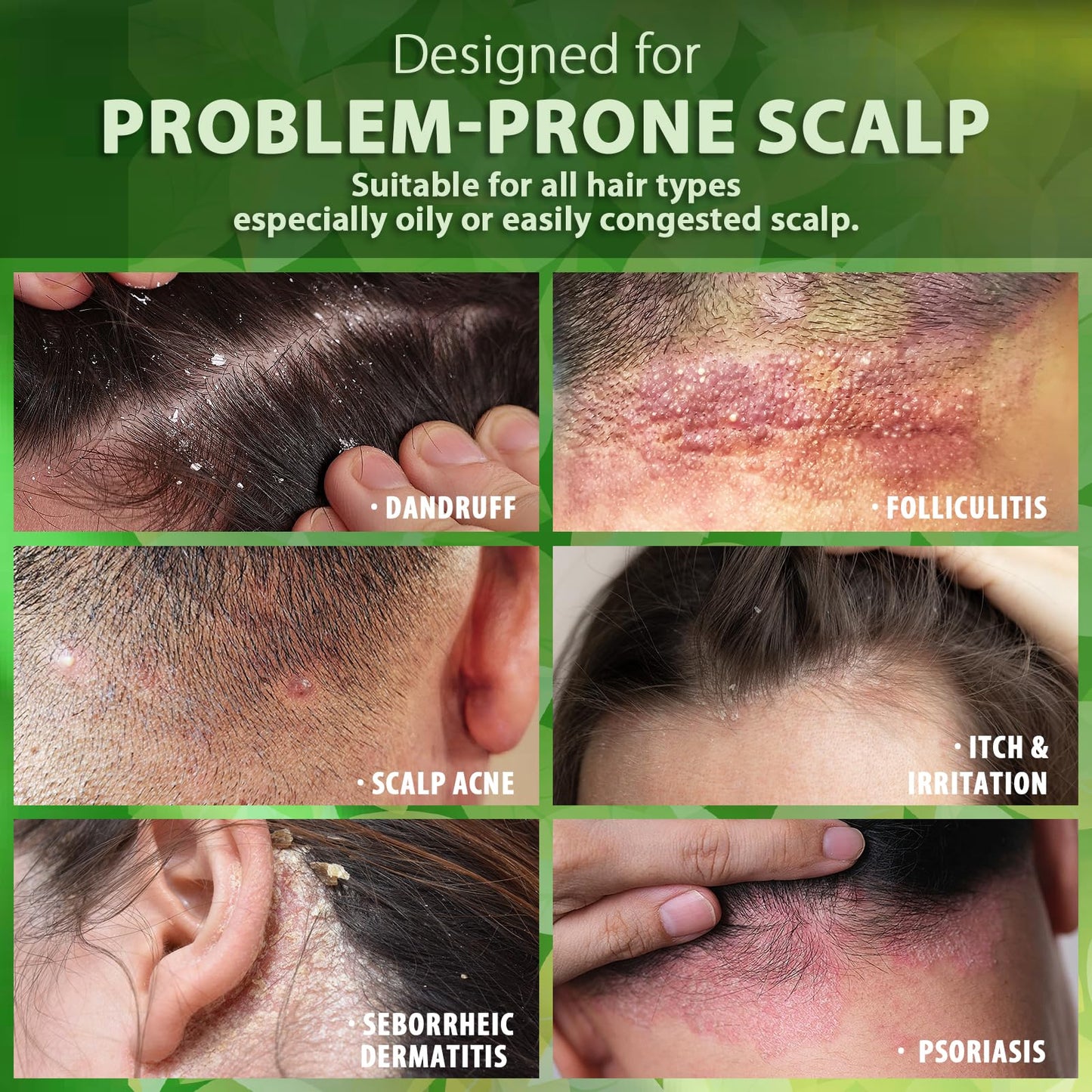 Recuren Plus Folliculitis Treatment Anti-Fungal Scalp Shampoo: Antifungal Scalp Cleanser for Seborrheic Dermatitis, Psoriasis, Acne, Dry & Itchy Scalp Relief — Sulfate-Free