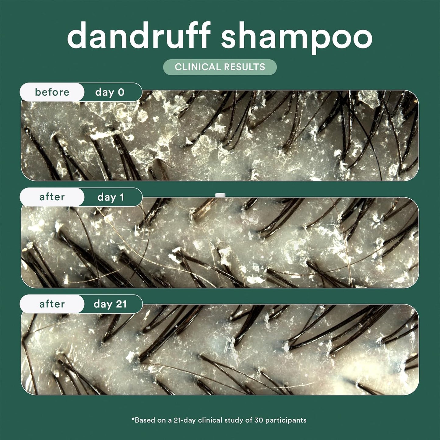 Dandruff Shampoo - Clinical Strength Relief with 3% Salicylic Acid | Gentle Cleansing Formula