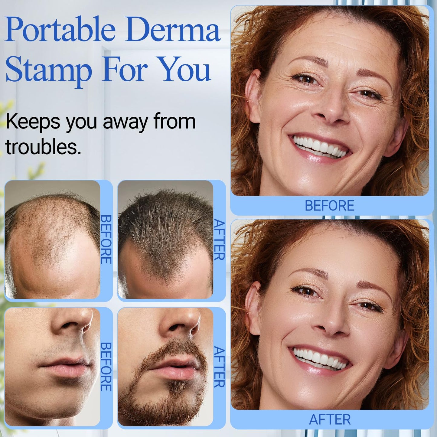 Microneedling Stamp - ANSIOVON Derma Stamp for Hair, Face & Scalp | At-Home Dermastamp for Men & Women