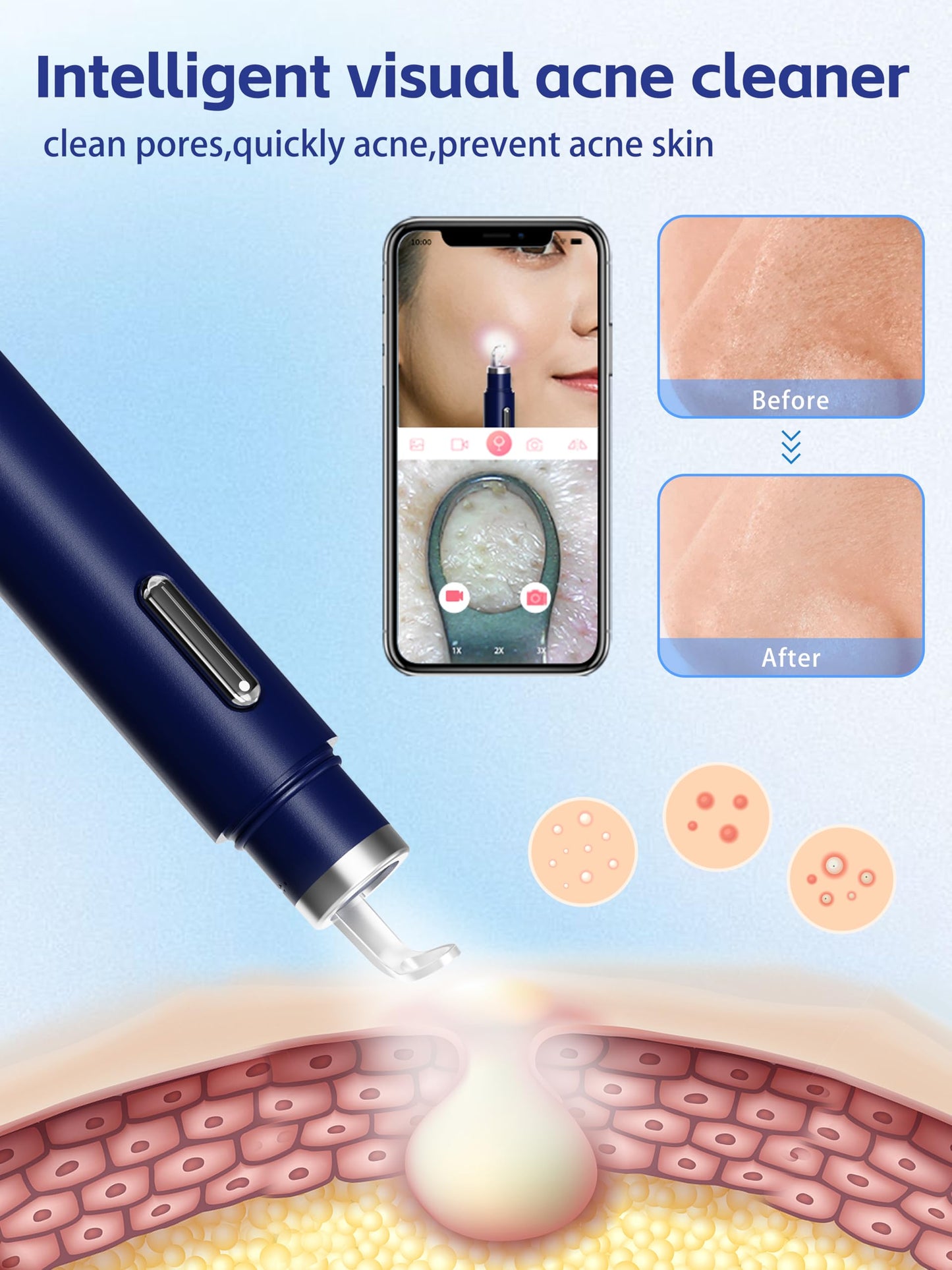 Visual Blackhead Remover with Camera 20X Extractor Kit for iPhone/Android