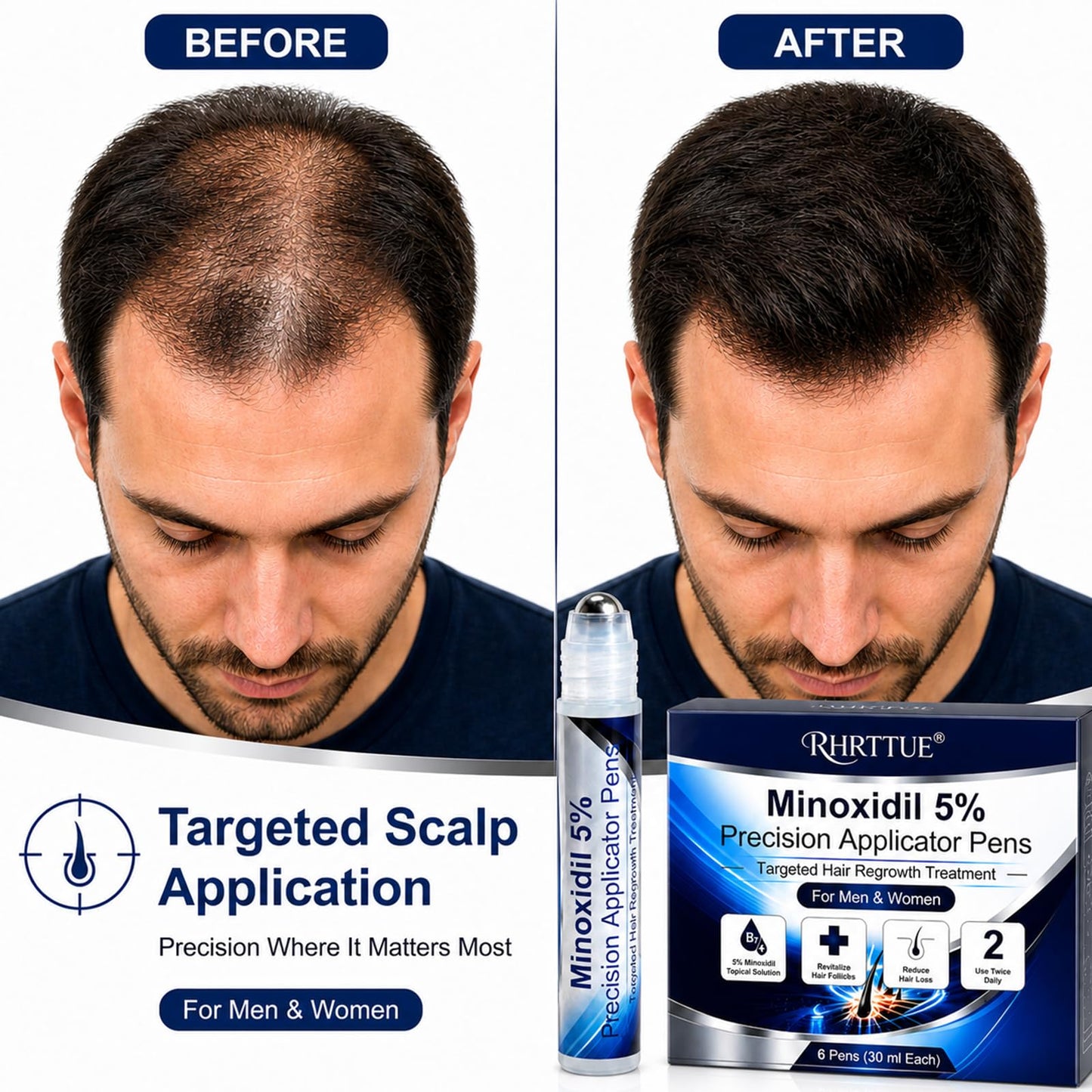 Minoxidil 5% Hair Growth Serum Roll On, Precision Applicator Pens for Men & Women, Topical Hair Regrowth Treatment, Targeted Scalp Application, Easy Dosage Control, 6 Pens x 30 mL