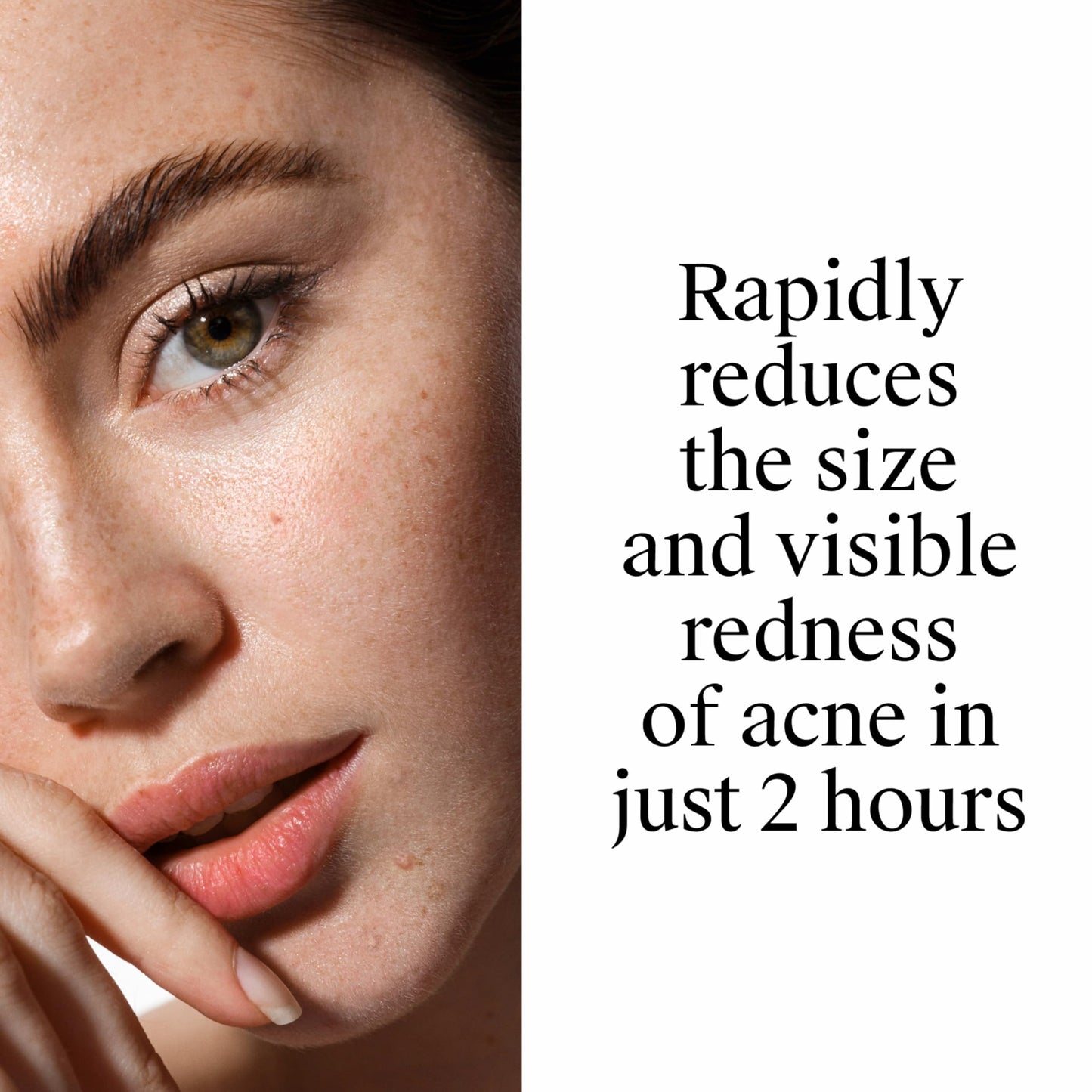 Neutrogena Rapid Clear Stubborn Acne Spot Treatment Gel, Maximum Strength 10% Benzoyl Peroxide Treatment Medication for Acne Prone Skin, Pimple Cream Reduces Size & Redness, 1 oz