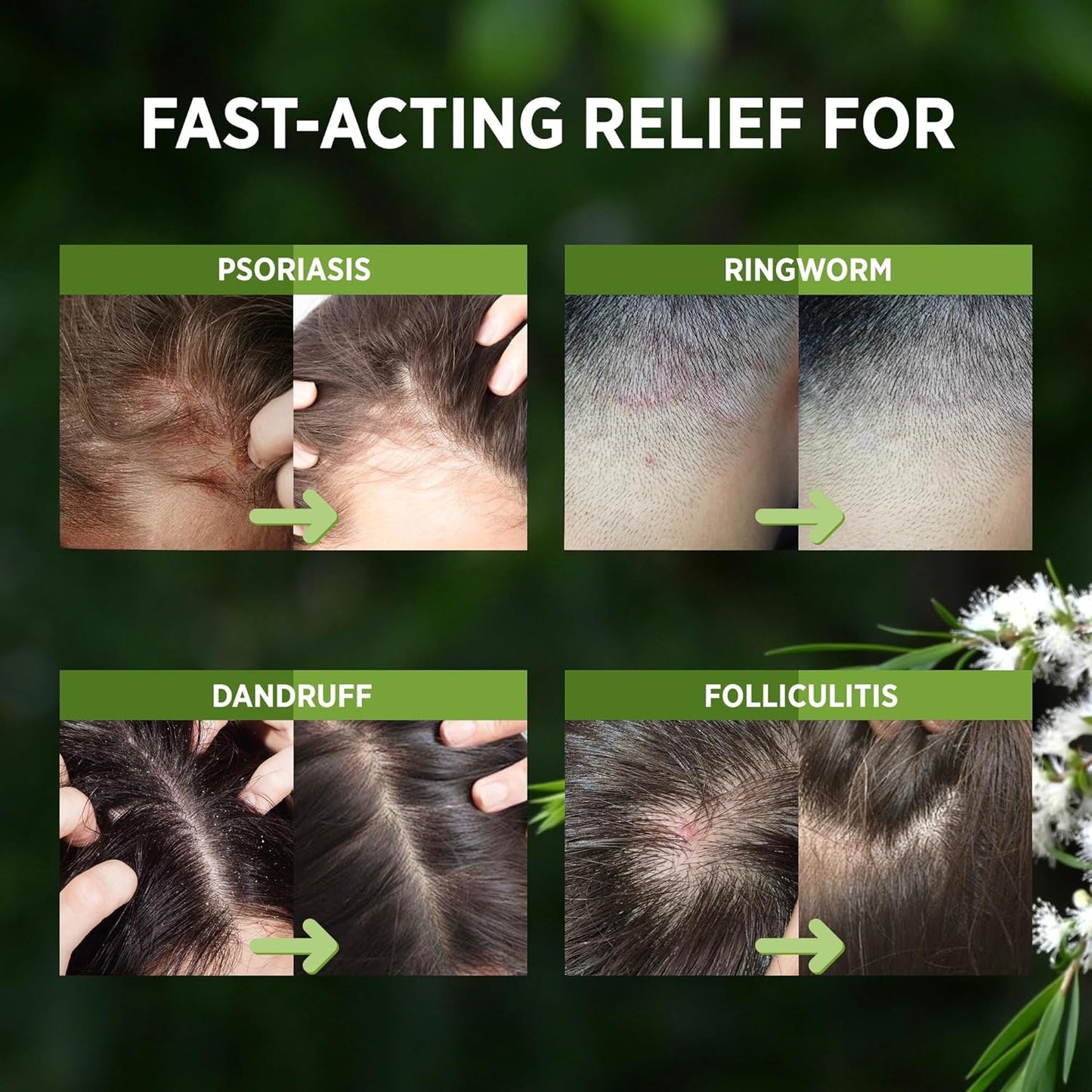 Tea Tree Scalp Relief Spray - Comfort & Hydration for Healthy Hair | Unisex Conditioning Support