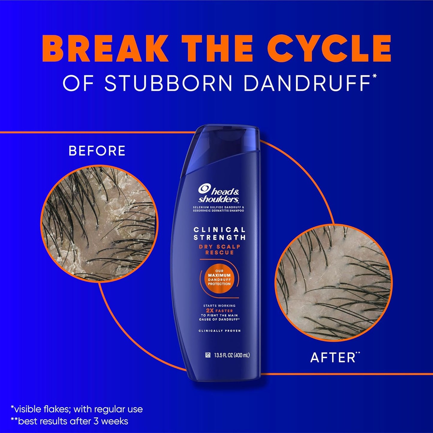 Head & Shoulders Anti-Dandruff Shampoo - Clinical Strength Dry Scalp Rescue, 1% Selenium Sulfide | 13.5 fl oz + Conditioner 9.1 oz