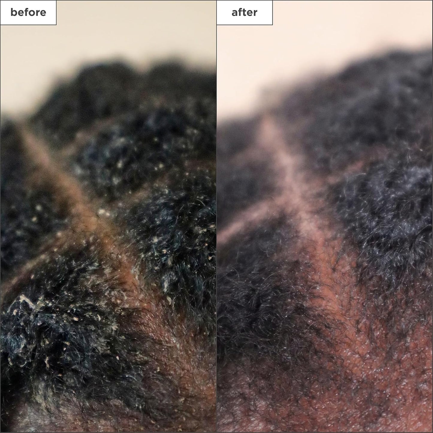 Briogeo Scalp Revival Charcoal & Tea Tree Treatment - Hydrating Leave-In Serum for Dry, Flaky Scalp | 1 oz
