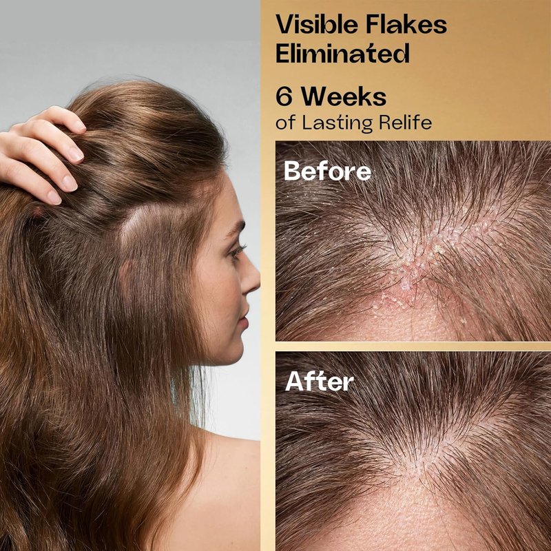 Anti-Dandruff Shampoo - Oil & Flake Control for Itchy Scalp Relief | 13.5 Fl Oz, All Hair Types