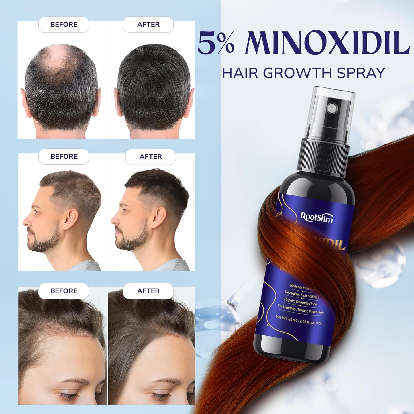 Minoxidil Hair Growth Treatment - 5% Extra Strength for Men & Women | 3-Pack, 180 ML, Rosemary Infused for Thinning Hair