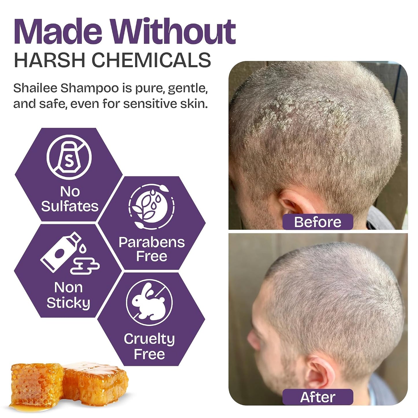Psoriasis Shampoo - Antifungal Treatment for Eczema, Folliculitis & Seborrheic Dermatitis | Manuka Honey Formula