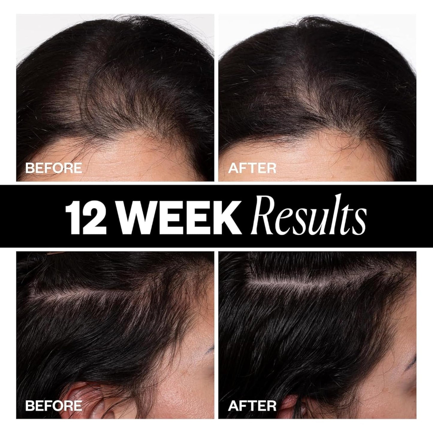 IGK Scalp Treatment for Hair Growth - Thickening Serum for Thinning Hair | Clinically Tested 2.1 Oz