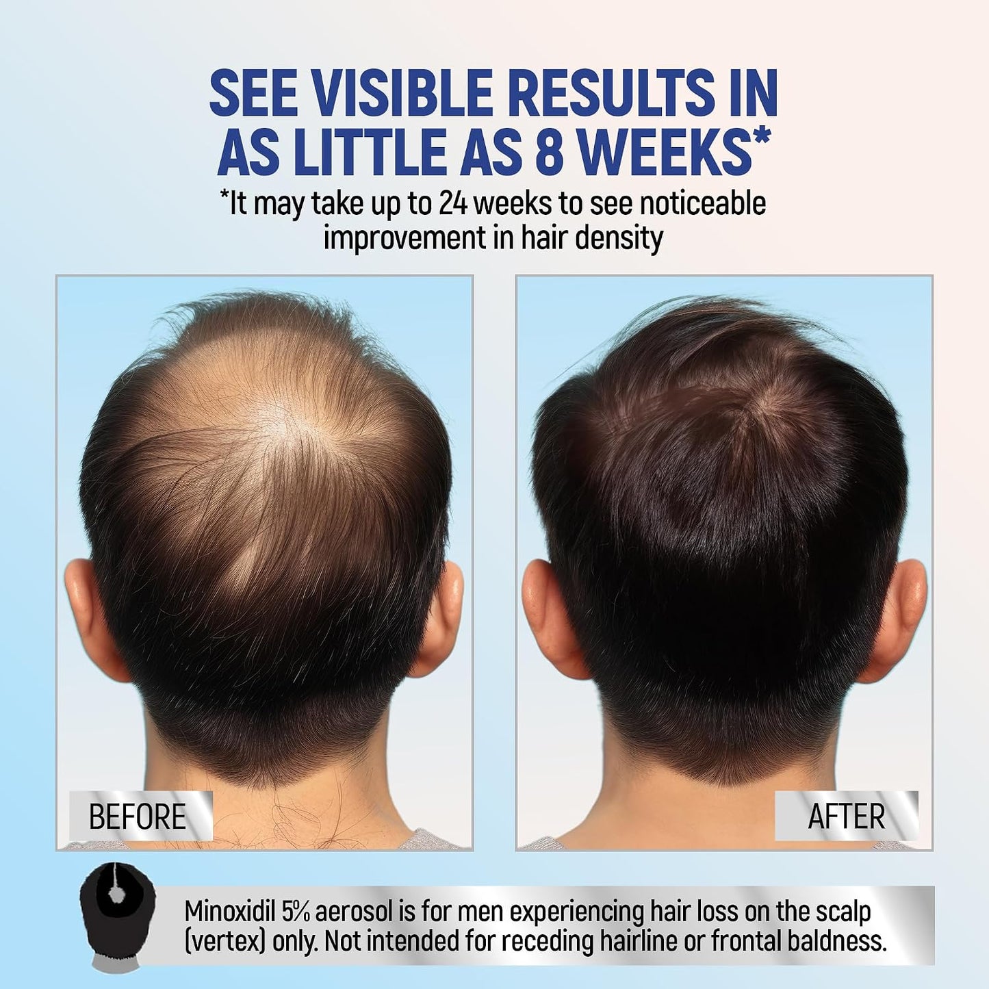 Minoxidil 5% Hair Regrowth Foam - 4-Month Treatment for Men | 2.11 oz (4 Pack)
