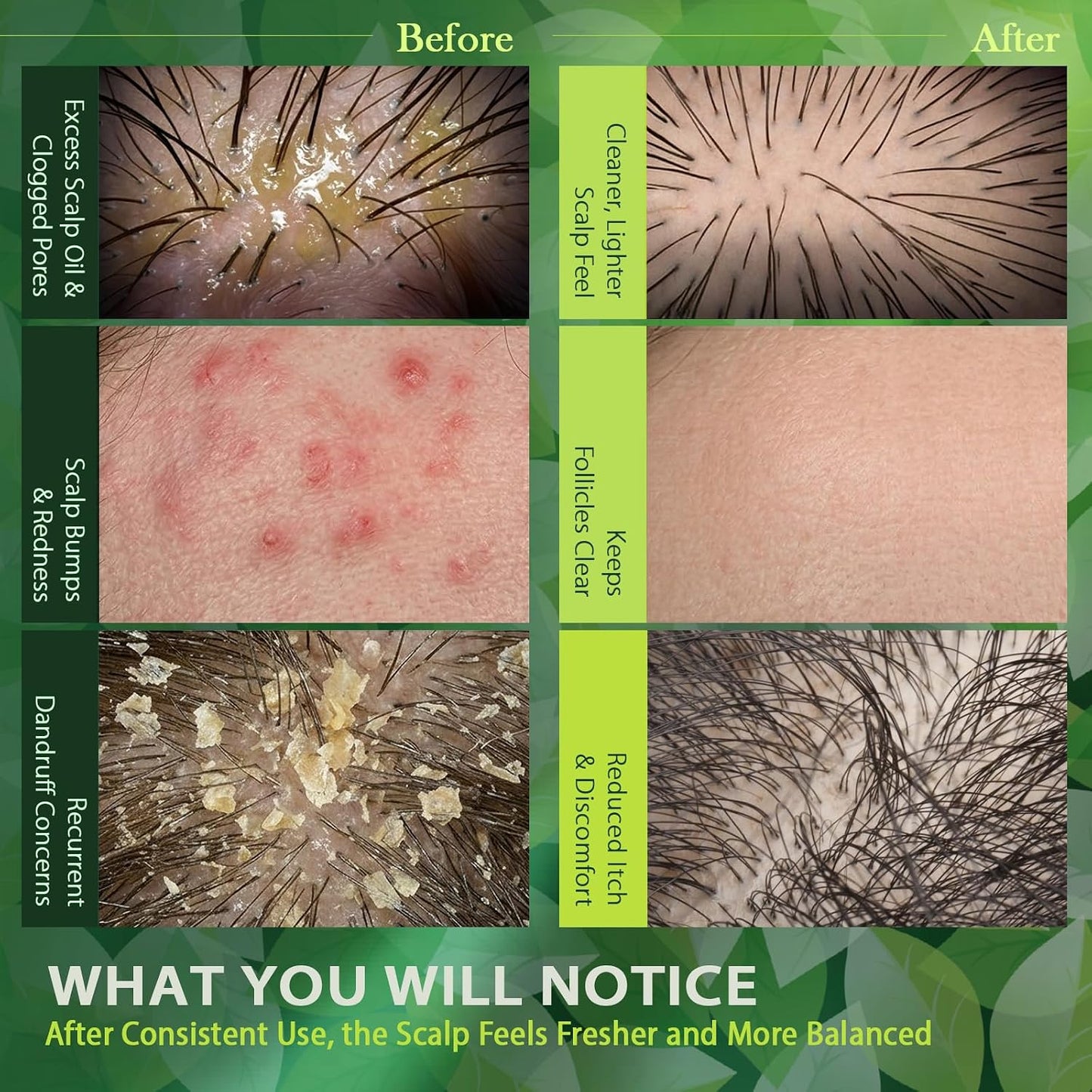 Folliculitis Treatment Shampoo - Anti-Fungal Scalp Cleanser for Seborrheic Dermatitis & Psoriasis | Sulfate-Free, Itchy Scalp Relief