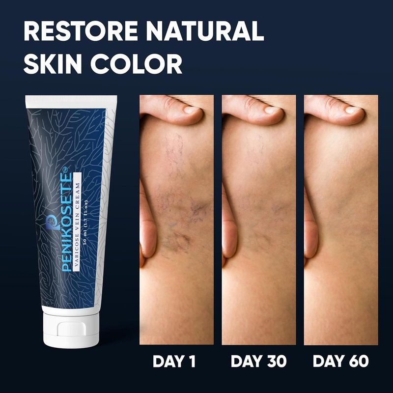 Varicose & Spider Vein Cream for Legs - Ayurvedic Ashwagandha Formula | Natural Non-Sticky Relief for Tired, Swollen Legs - 1 Pack