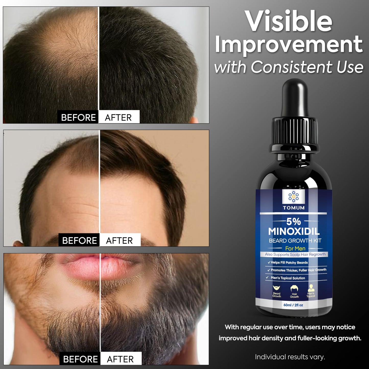 TOMUM 5% Minoxidil Beard Growth Kit for Men – Hair & Beard Regrowth Serum, Helps Fill Patchy Beards, Thicker Fuller Facial & Scalp Hair, Topical Solution