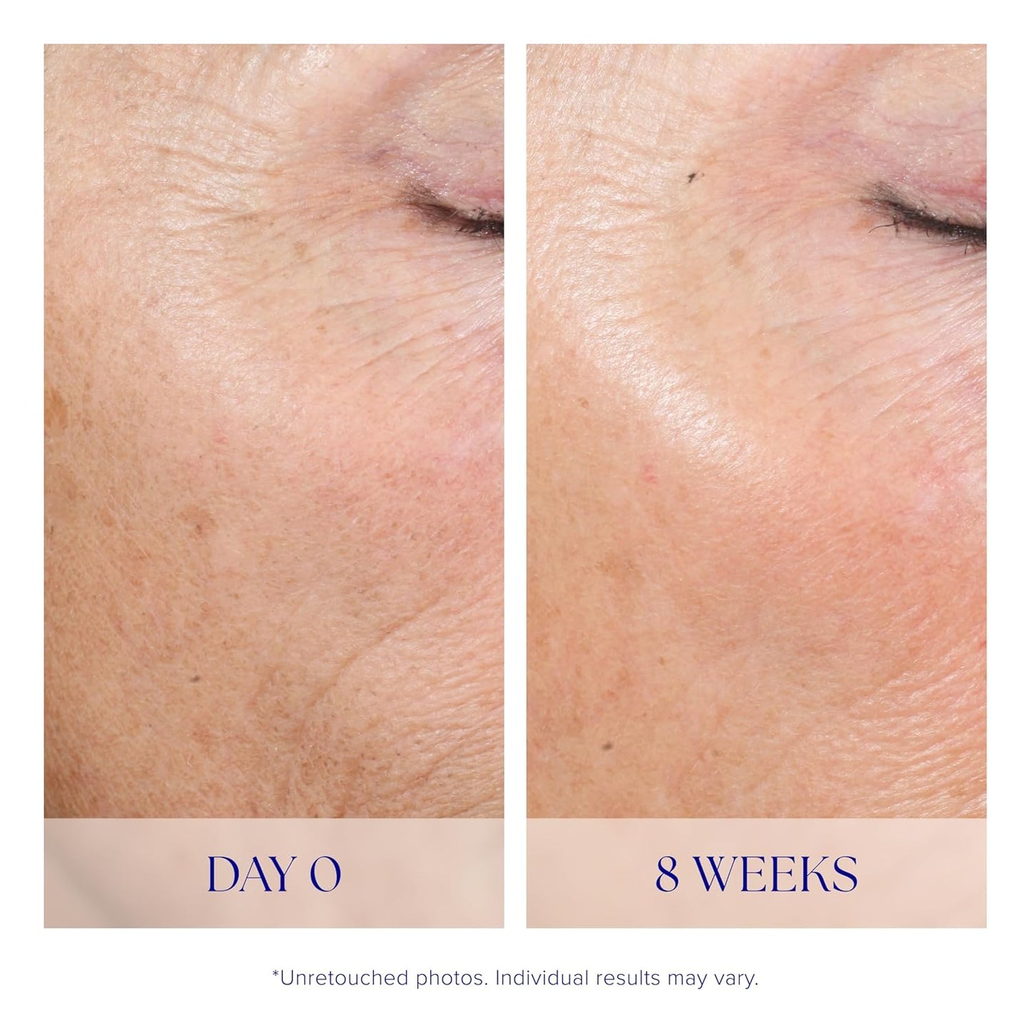 iS CLINICAL Active Peel System - Two-Step Gentle At-Home Face Exfoliation Treatment